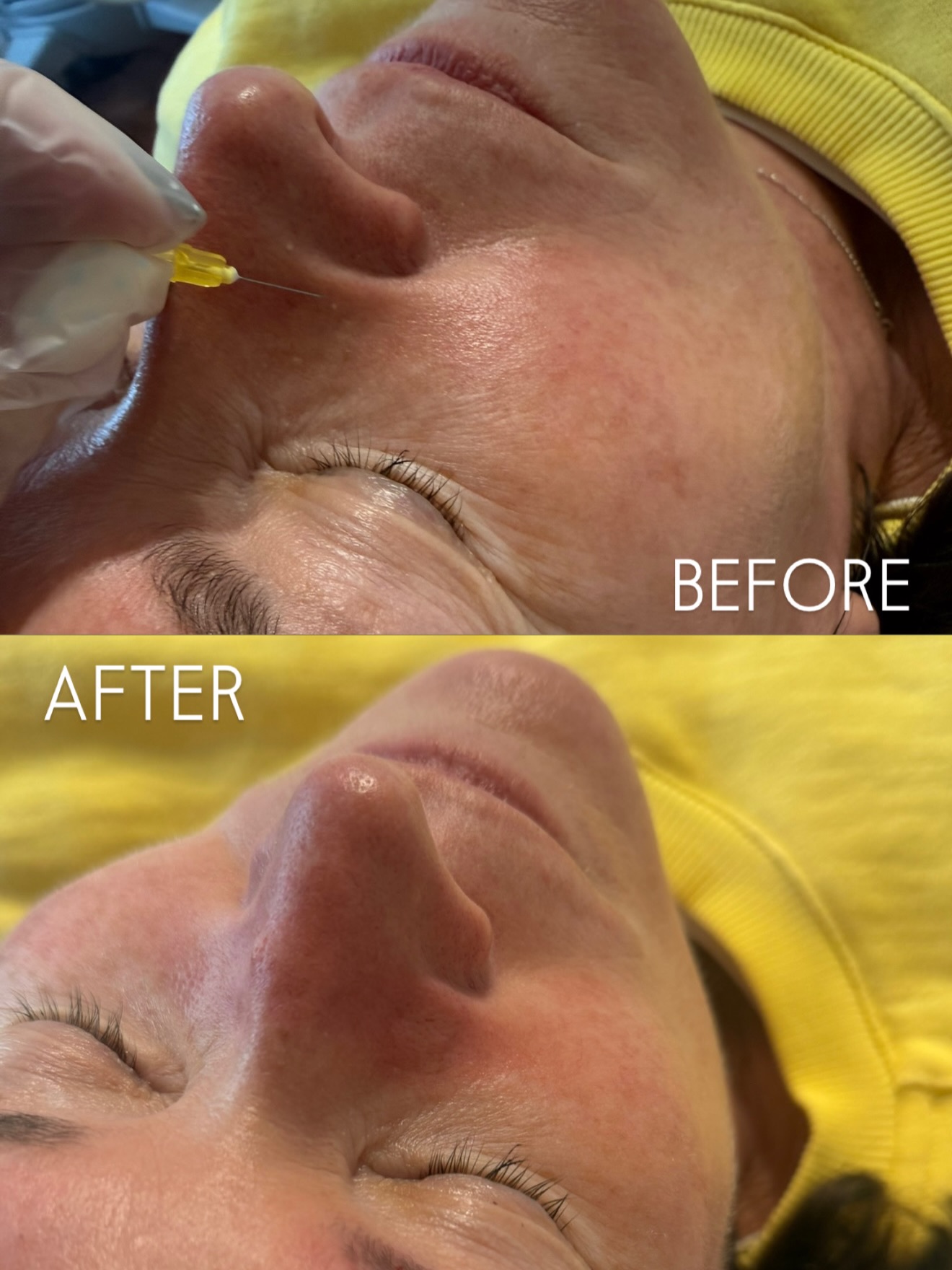 Recent treatments…
Milia Removal
Polka dot Biab
Microneedling
Dermaplanning
Anti-wrinkle
#cheltenham #bathroadsalon #cotswolds #gloucestershire #skinclinic