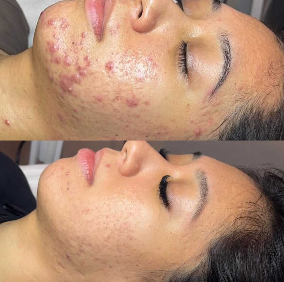 A personalized skincare routine, monthly treatments, and finding what triggers your acne is what will lead you to the clear skin you’ve been daydreaming about ☁️✨
Skin transformation by Eva, achieved through @facerealityskincare home care and monthly treatments
#renoskincare #renoskincarespecialists #facereality
