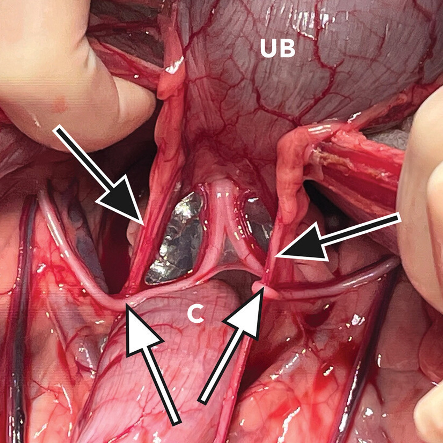 View of the caudal abdomen with the patient in dorsal recumbency and the bladder retroflexed with the image taken from cranial to caudal.
the vas deferens (white arrows with black outline) can be seen passing over the ureters (black arrows with white outline) bilaterally.
C = Colon. UB = Urinary bladder.
Paramedian incisions increase complication risk in cryptorchid castration. Faulkner JAVMA 2025 shows incision choice matters for exposure and safety, with prostate trauma most common and many complications identified intra- or early post-op.
Paramedian skin incision increased odds of complications (OR 4.01; 95% CI 1.45 to 11.1) compared to parapreputial, and paramedian abdominal incision increased odds (OR 3.4; 95% CI 1.5 to 7.4) compared to ventral midline. Most common complication was prostate trauma.