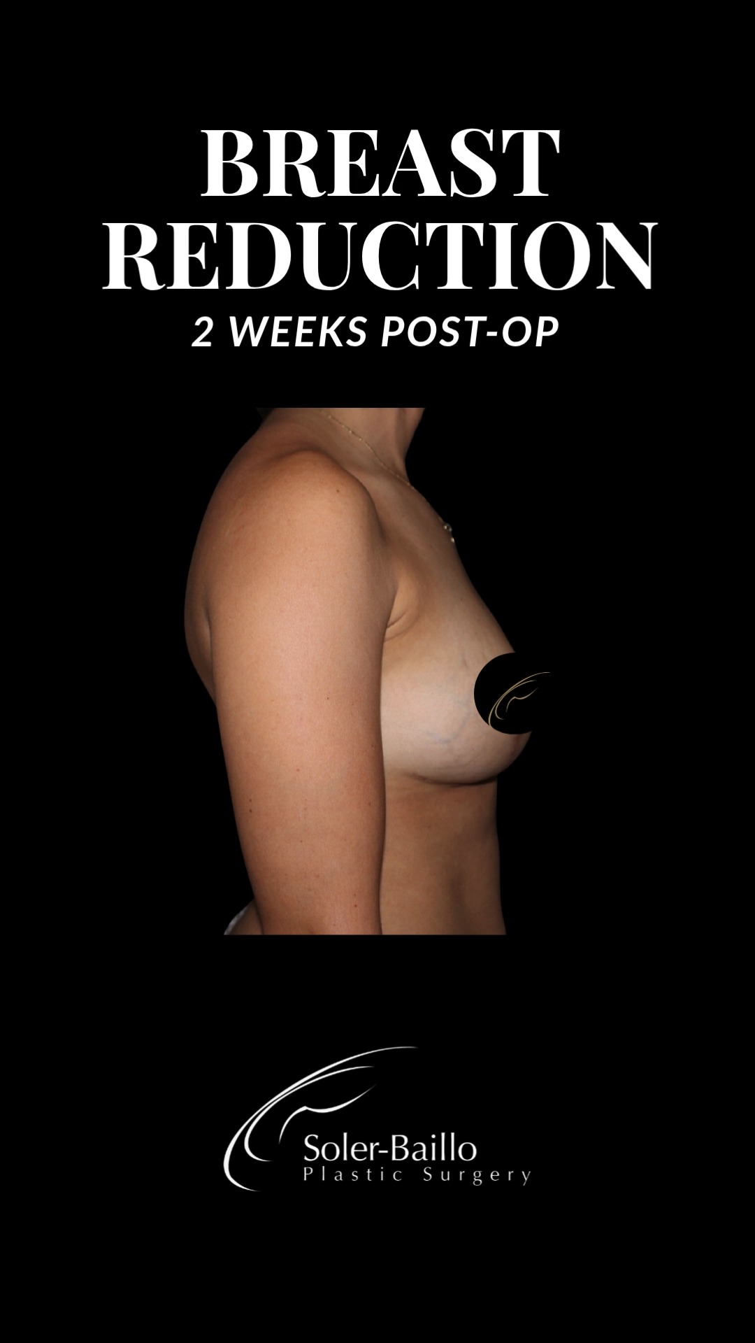 Less weight. More life. ✨
Breast reduction surgery, or reduction mammaplasty, is a procedure designed to remove excess breast tissue, fat, and skin to achieve a breast size more proportionate to the body. Beyond aesthetic improvement, it can significantly relieve chronic back, neck, and shoulder pain, reduce skin irritation, and improve posture and mobility.
Ready to feel the difference? Schedule your consultation with Soler-Baillo Plastic Surgery today and take the first step toward lasting relief and confidence.
#BreastReduction #SolerBailloPlasticSurgery #BreastReductionCoralGables #BreastReductionResults #BreastReductionSurgeon