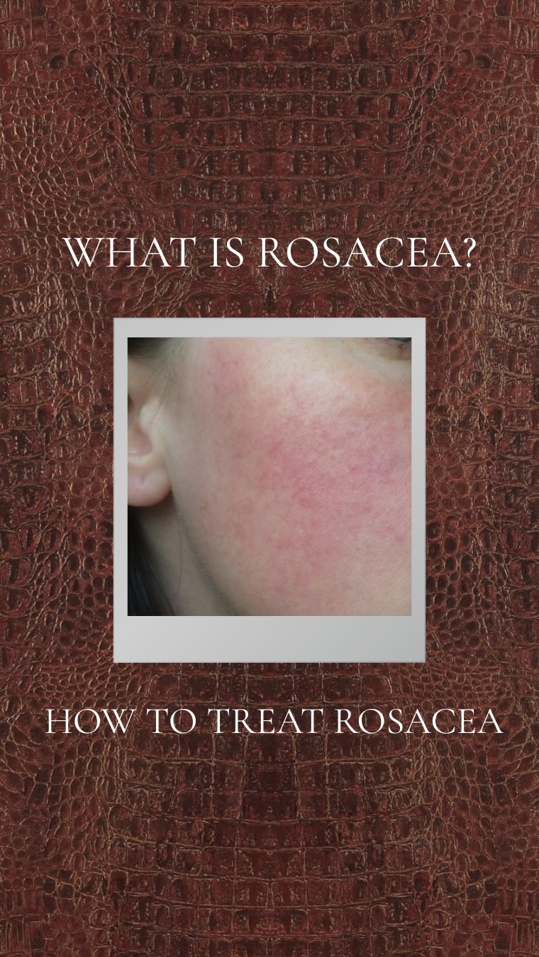 Rosacea isn’t just “a little redness.”
It’s a chronic skin condition that can flare with triggers like heat, stress, spicy foods, or harsh products.
Understanding your skin is the first step to calming it; gentle care, consistent routines, and the right treatments can make a real difference. 💌
#RosaceaAwareness #SensitiveSkin #SkinHealth #medicalaesthetics #medispa
•
•
•
{Edmonton Medi spa • Sherwood park Medi spa • Fort Sask Medi spa • Medical Aesthetics • yeg Medi spa • yeg • Chemical Peels • IPL • microneedling • hydrafacial • injectables • Botox • dysport • nuceiva • fillers • Revenesse • Teoxane • InMode • Alumier • ColoreScience • Skinceuticals • Chin Filler • Cheek Filler • Lip Filler • Brow Waxing • Laser Hair Removal • rosacea}