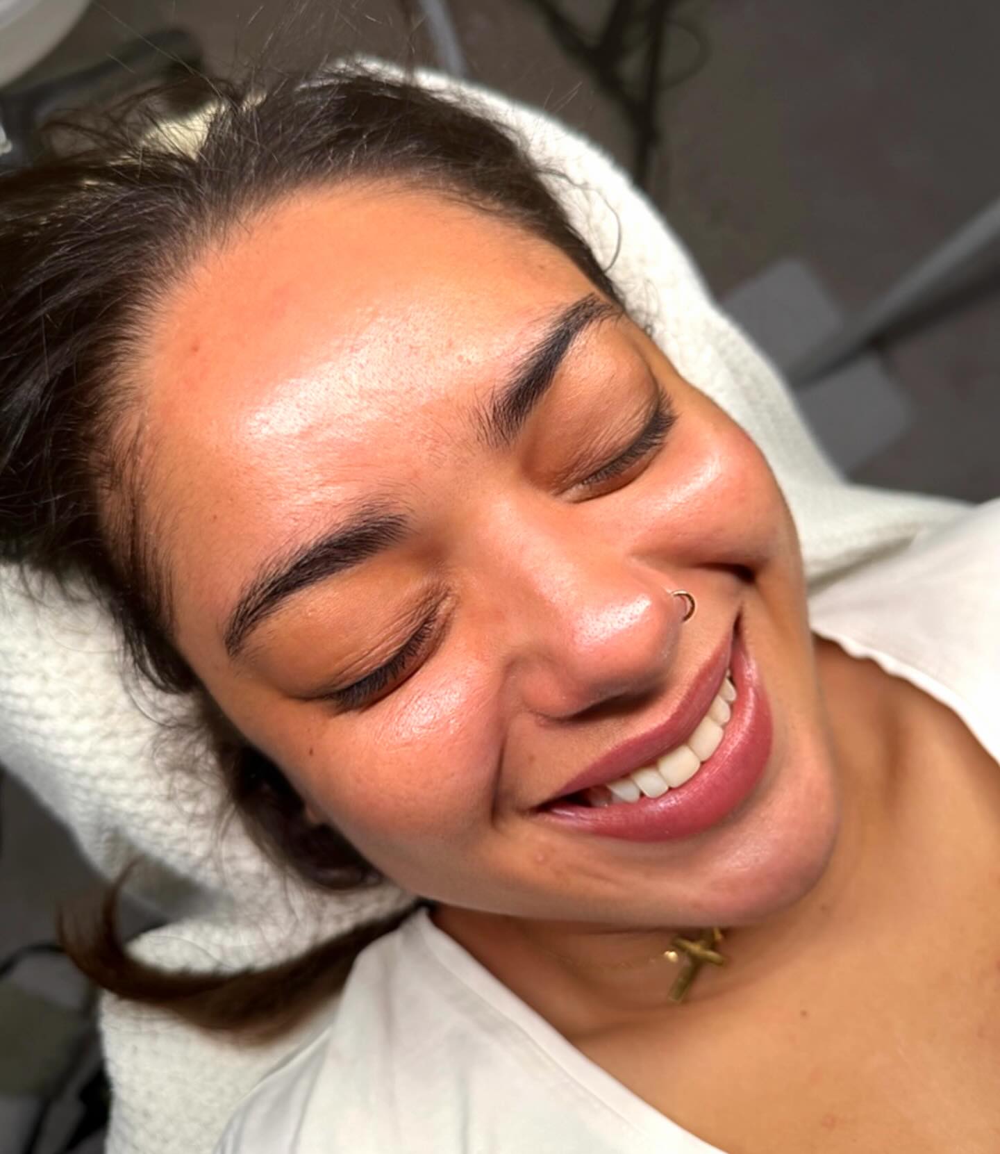 Glass skin, hallelujah
Yes, I’ll keep going with this tren.
Our Beautiful Vianisis
#zurich #happiness #beauty #acne #facial