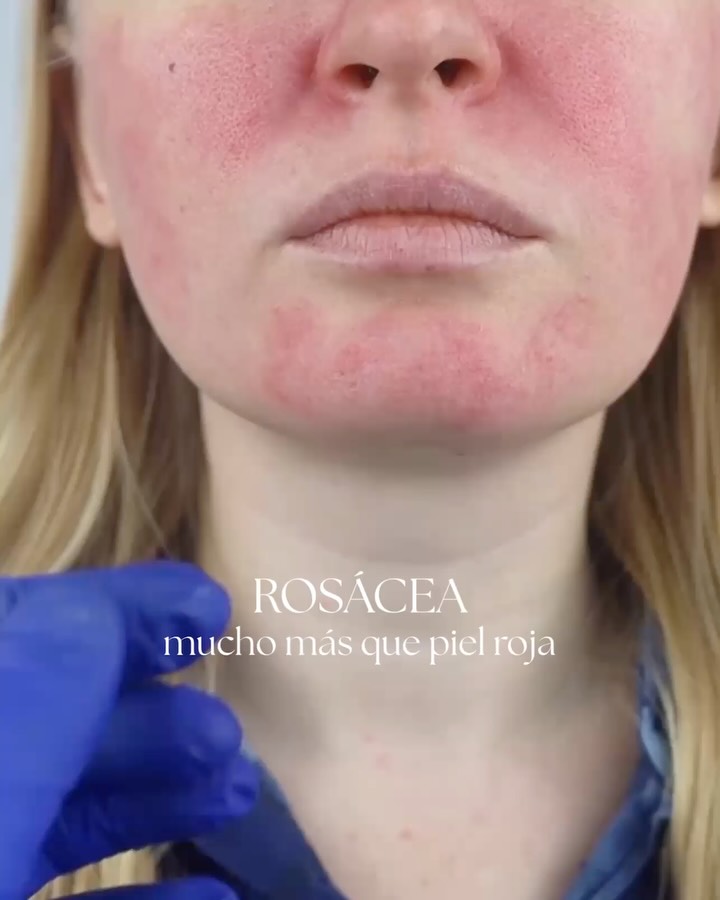 Tras más de 18 años dedicada a la dermatología, con especial foco en piel sensible y rosácea, sé que no hay dos casos iguales.
Cada caso tiene sus desencadenantes, su evolución y su forma de responder al tratamiento.
Por eso, más allá de tratar un brote puntual, el objetivo es entender qué está pasando en esa piel:
inflamación, alteración vascular, disfunción de la barrera o desequilibrios en la microbiota. El abordaje siempre es personalizado y combina tratamiento médico, cuidado cosmético específico y, cuando está indicado, tecnologías como láser o luz pulsada.
Porque la rosácea es una enfermedad compleja que no se trata igual en 2 pacientes.
Se controla con experiencia, buen diagnóstico y un plan adaptado a cada paciente.
#rosacea
#dermatologiaclinica
#dermatologiapreventiva
#dermatologiapremium
#estheamedica