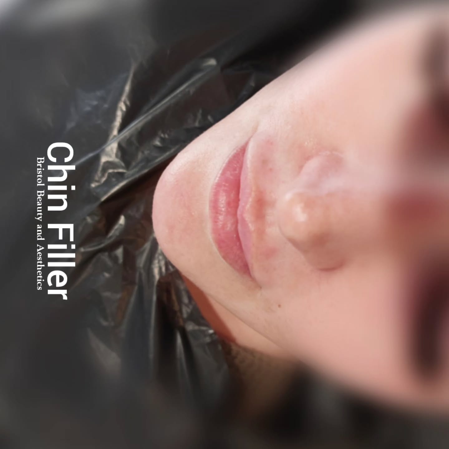 Thinking about getting chin fillers? 🤔 It's a cosmetic treatment that uses injections to add volume and definition to your chin area. People often opt for it to improve their profile, create a more balanced facial structure, or even to reduce the appearance of a double chin. It's a pretty quick procedure, usually done in-office with minimal downtime. The results can be quite natural-looking, giving you a subtle enhancement. So, if you're curious about boosting your chin's appearance, fillers might be worth exploring! 💉✨ #ChinFiller #AestheticBeauty #FacialSculpting #bristolaesthetics