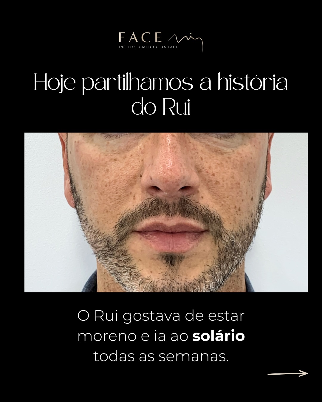 O nosso querido paciente Rui é a prova que os solários e a exposição solar intensa é um dos piores inimigos da nossa pele, da nossa saúde e do nosso envelhecimento.
O Carcinoma Basocelular é um cancro de pele pouco invasivo mas que pode deixar cicatrizes e marcas para toda a vida. O Melanoma é o cancro de pele que mais mata. Para ambos o maior de fator de risco é a exposição solar e uso de solários.
A tecnologia de laser é a maior aliada dos pacientes com fatores de risco para cancro da pele e um dos melhores tratamentos para melhorar a qualidade da nossa pele durante a vida adulta.
Os lasers são capazes de rescrever a genética da nossa pele através da modificação do comportamento das nossas células para um comportamento mais jovem e saudável.
Use protetor solar, não se exponha em demasia, NÃO use solários e proteja as crianças. Porque o maior risco para o cancro de pele e o envelhecimento precoce é a exposição solar e as queimaduras em idades tenras.
Marque a sua consulta médica e saiba como podemos ajudar.
#lasercancropele #bbllaser #facemi #laserhalo #facemiporto
Os casos clínicos apresentados refletem o antes e depois de pacientes específicos. Cada pessoa é única e o resultado pode variar de paciente para paciente.
Todos os pacientes, antes de cada procedimento, passam por um processo de consulta médica de diagnóstico onde são avaliadas indicações, expectativas e motivações.
Registo ERS: 21236
Registo estabelecimento: E159774
Licença funcionamento: 21236/2022