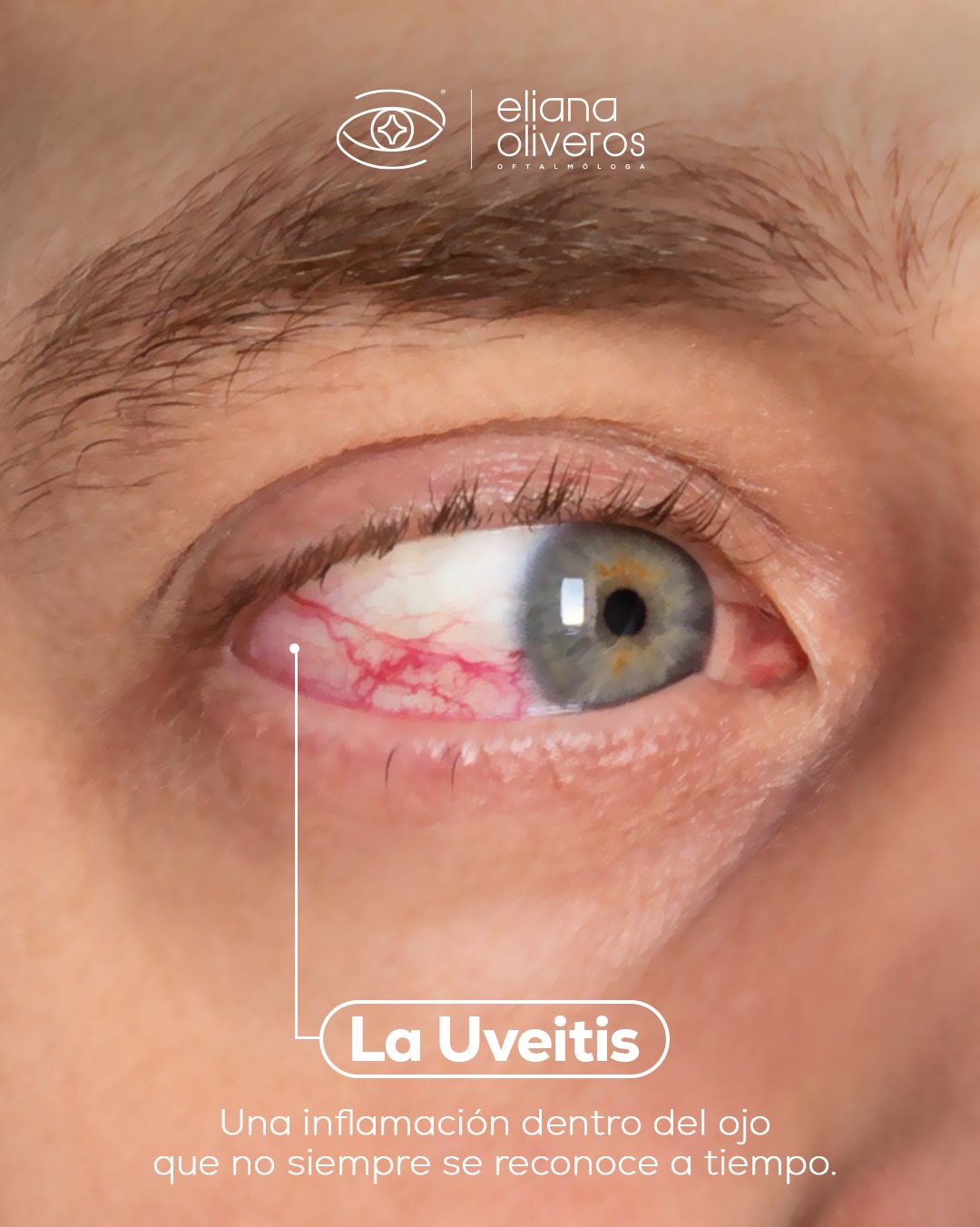 A simple vista, un ojo rojo puede parecer cansancio o alergia ⚠️ pero ¿qué pasa cuando el problema está en el interior?
La uveitis no es una simple molestia pasajera. Es una inflamación profunda que ataca directamente la zona encargada de nutrir y proteger tu visión 👁️
✍️Ignorar sus señales esperando a que “se pase solo” o automedicarse puede tener consecuencias graves para tu salud visual a largo plazo.
Desliza en el carrusel para conocer cómo identificarla a tiempo ✨.