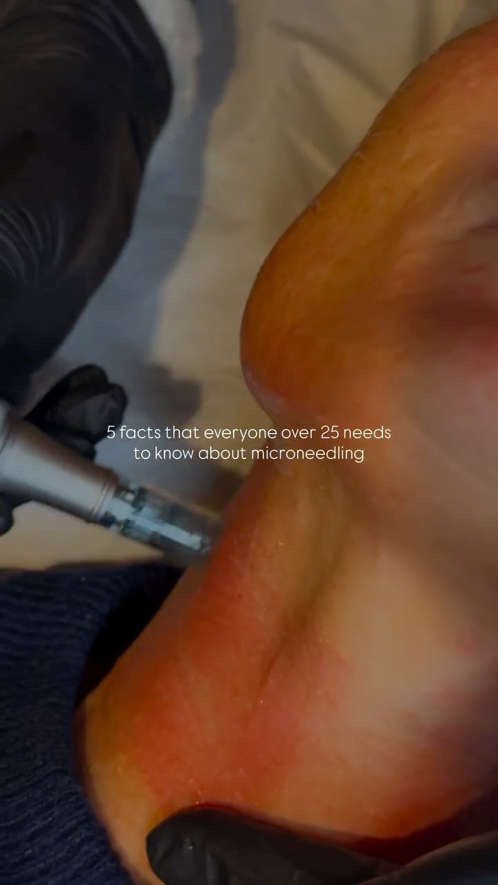If you are in your mid-20s or beyond, your skin is already producing less collagen than it was. Microneedling is one of the most effective ways to change that.
It creates controlled micro-injuries in the skin that trigger your body’s natural repair response. New collagen, new elastin, better texture, reduced scarring, smaller pores. The results build over time and they last.
1. Your collagen production starts declining in your mid-20s. Microneedling stimulates it back into action.
2. It works on more than wrinkles. Acne scarring, enlarged pores, uneven texture and pigmentation all respond well.
3. The downtime is real but short. Expect redness for 24 to 48 hours. After that your skin starts doing the work.
4. One session is not enough. A course of three to six delivers the results people actually post about.
5. The earlier you start the easier it is to maintain. Prevention is always cheaper than correction.
DM to book a free consultation.
#cheltenham #salon #gloucestershire #beautysalon