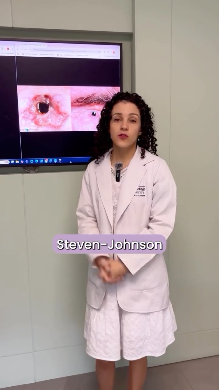 El Síndrome de Stevens-Johnson es una patología extremadamente grave que ataca directamente la superficie del ojo , afectando de forma severa la conjuntiva, la córnea y los párpados ⚠️
Su manejo debe ser estrictamente multidisciplinario. A nivel oftalmológico, el daño puede ser tan profundo que a menudo exige cirugías mayores de alta especialidad, como la implantación de dispositivos complejos (por ejemplo, una queratoprótesis o córnea artificial) para intentar salvar y restaurar la visión ✨
💬 Conocías sobre esta patología?