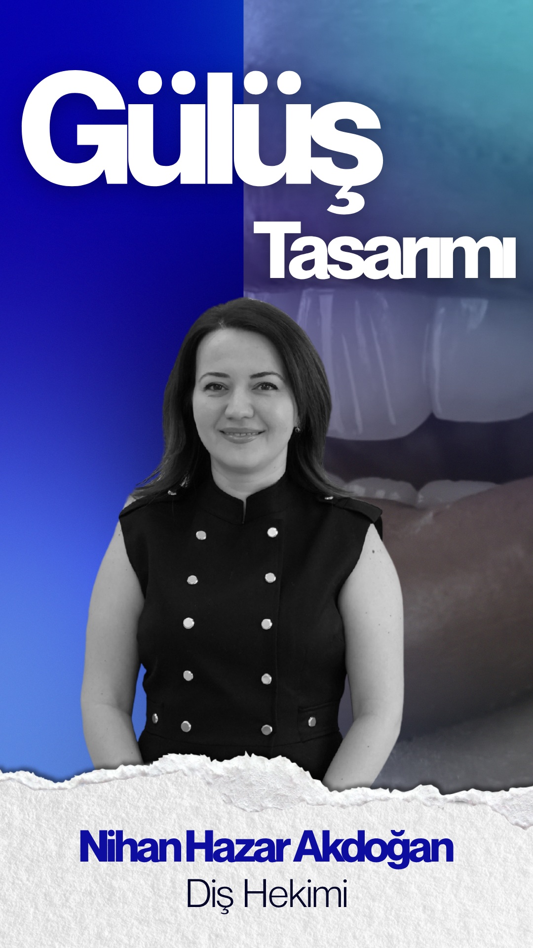Sosyal medyada gördüğünüz o estetik gülüşler…
Peki gerçekten size uygun mu?
Dr Nihan Hazar Akdoğan olarak her hastamızda tek bir standardı değil,
kişiye özel bir gülüş tasarımını planlıyoruz.
Gülüş tasarımı; sadece dişlerin rengini değiştirmek değil,
yüz hatlarınız, dudak yapınız ve diş formunuz ile birlikte
doğal ve dengeli bir görünüm oluşturmayı hedefler.
Her bireyin ihtiyacı farklı olduğu için süreç;
öncelikle detaylı bir muayene ve analiz ile başlar.
Sonrasında size özel tedavi planı oluşturulur.
Uygun görülen durumlarda;
lamine, zirkonyum ya da farklı estetik uygulamalar tercih edilebilir.
Ama unutulmamalıdır ki;
her işlem her hasta için uygun olmayabilir.
Eğer siz de gülüşünüzle ilgili bir değişim düşünüyorsanız,
öncelikle bir diş hekimi değerlendirmesi ile ilerlemek en doğru adımdır.
📍 Detaylı bilgi için bizimle iletişime geçebilirsiniz.