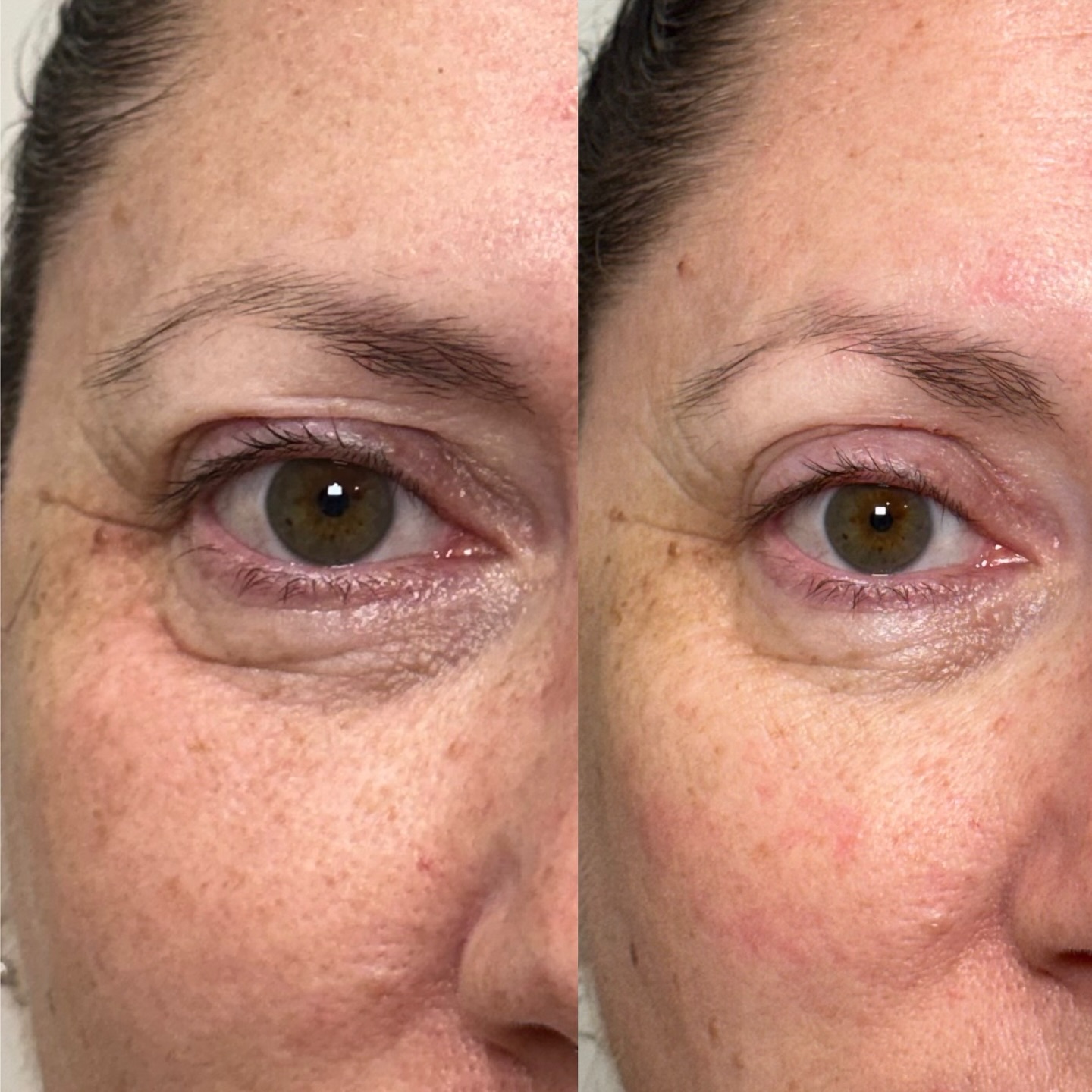 Subtle, natural skin rejuvenation
Shared with consent for education,
This patient was treated with a bio-regenerator treatment @sunekos_australia and this is the result post FIRST treatment.
This treatment is designed to support skin quality, hydration, and overall freshness — without adding volume or changing your natural features.
Every face and every treatment journey is unique, which is why we take a personalised approach to help you achieve a refreshed, well-rested appearance.
If you’ve been feeling like your skin is looking tired, crepey, or lacking glow, this may be an option worth exploring.
• Suitable for delicate areas
• Focus on skin quality + hydration
• Tailored treatment plans
Curious if this is right for you?
Send us a message or book a consultation to chat through your options.
—
All treatments carry risks and results vary. A consultation is required to determine suitability.
—
Bare Beauty Brisbane Aesthetics Clinic
8 Stuart Street
Bulimba
QLD 4171
www.barebeautybrisbane.com
0416447277
#skinrejuvenation #bioregenerative #barebeautybrisbane #cosmeticclinic #bulimba