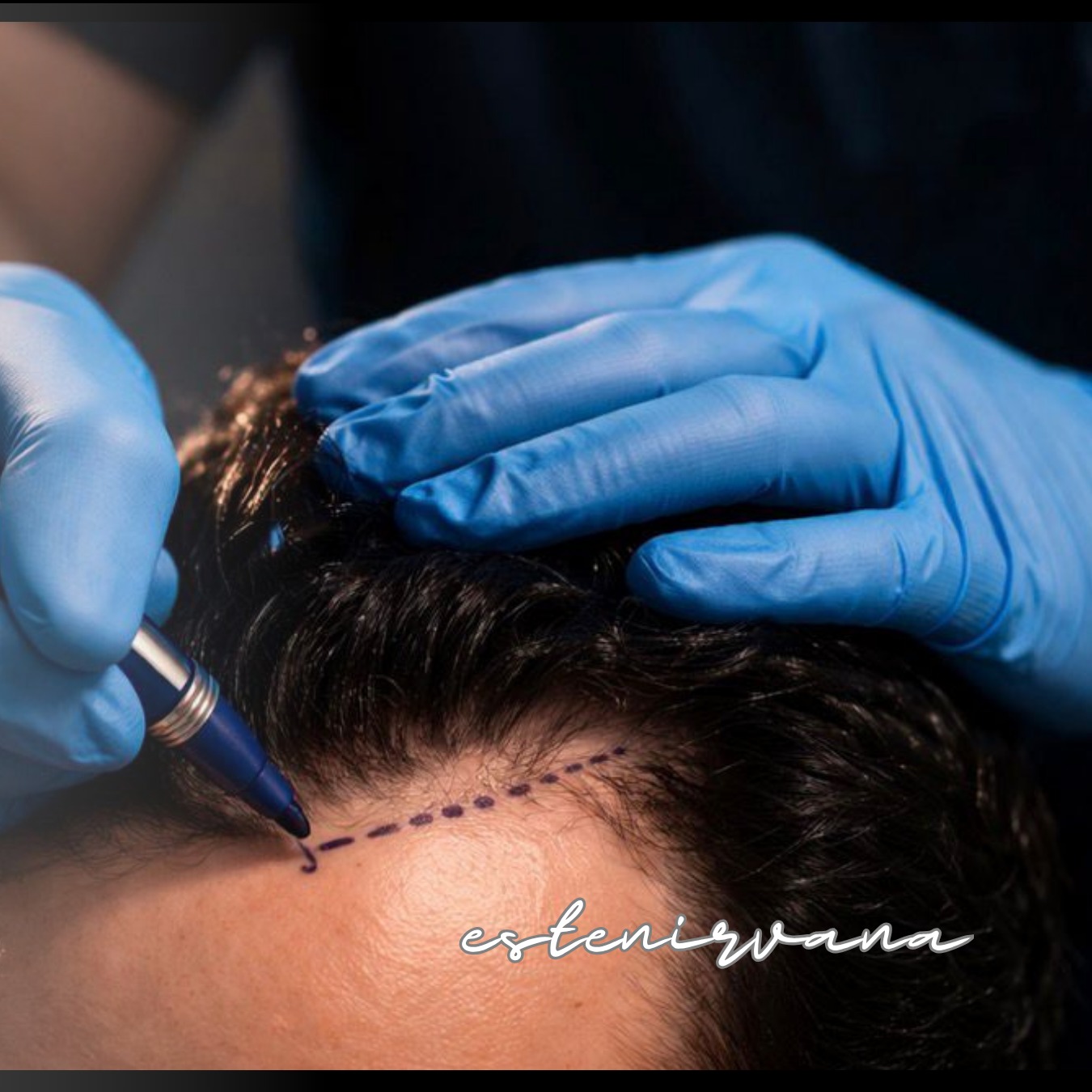 The Art of Natural Hairlines #HairlineDesign
#NaturalHairline
#HairTransplantTurkey
#HairlineGoals
#PerfectHairline