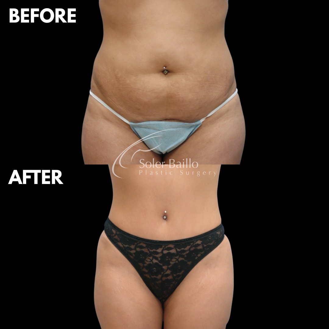 Where precision meets artistry 👨🏻⚕️ a refined approach to abdominal contouring. ✨
The Bikini Tummy Tuck™ Body Technique has been one of Dr. Soler-Baillo’s signature procedures since 2002, an original method designed for sculpted, natural-looking results with a discreet, bikini-friendly scar. 👙
This transformation also included muscle repair (plication) to restore core integrity and enhance a flatter, more defined silhouette.
💫 Real patient transformation
✔️ Flatter, tighter abdomen
✔️ Sculpted, feminine waistline
✔️ Muscle repair for improved contour
✔️ Low, concealed incision placement
✔️ Elegant, natural results
For those seeking a more elevated alternative to the traditional tummy tuck, this technique is designed with both structure and aesthetics in mind.
📍Coral Gables
🗓️ Schedule your private consultation today!
(305) 661-1996 #tummytuck #miami #plasticsurgery #before_and_after #drsolerbaillo