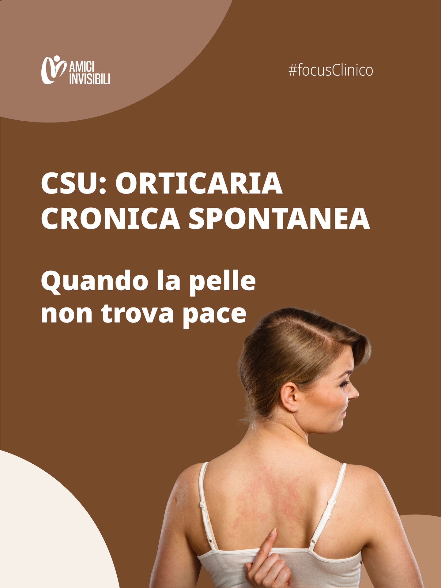 🔍 Focus clinico con il dott. Leonardo Gaglio:
Ti capita di soffrire di pomfi pruriginosi che compaiono senza un motivo apparente e persistono per settimane?
👉🏻 La cosiddetta CSU (Orticaria Cronica Spontanea) è una condizione legata ad un’attivazione anomala del sistema immunitario, spesso influenzata da stress, infezioni o fattori ormonali.
Non è “solo un’allergia”: la ricerca scientifica suggerisce meccanismi complessi come l’attivazione di mastociti e basofili.
Se il prurito e i pomfi persistono, una valutazione allergologica o dermatologica può aiutare a identificarne le caratteristiche e impostare un percorso terapeutico mirato.
E tu, conoscevi la CSU? Diccelo nei commenti 💬
#AmiciInvisibili #CSU