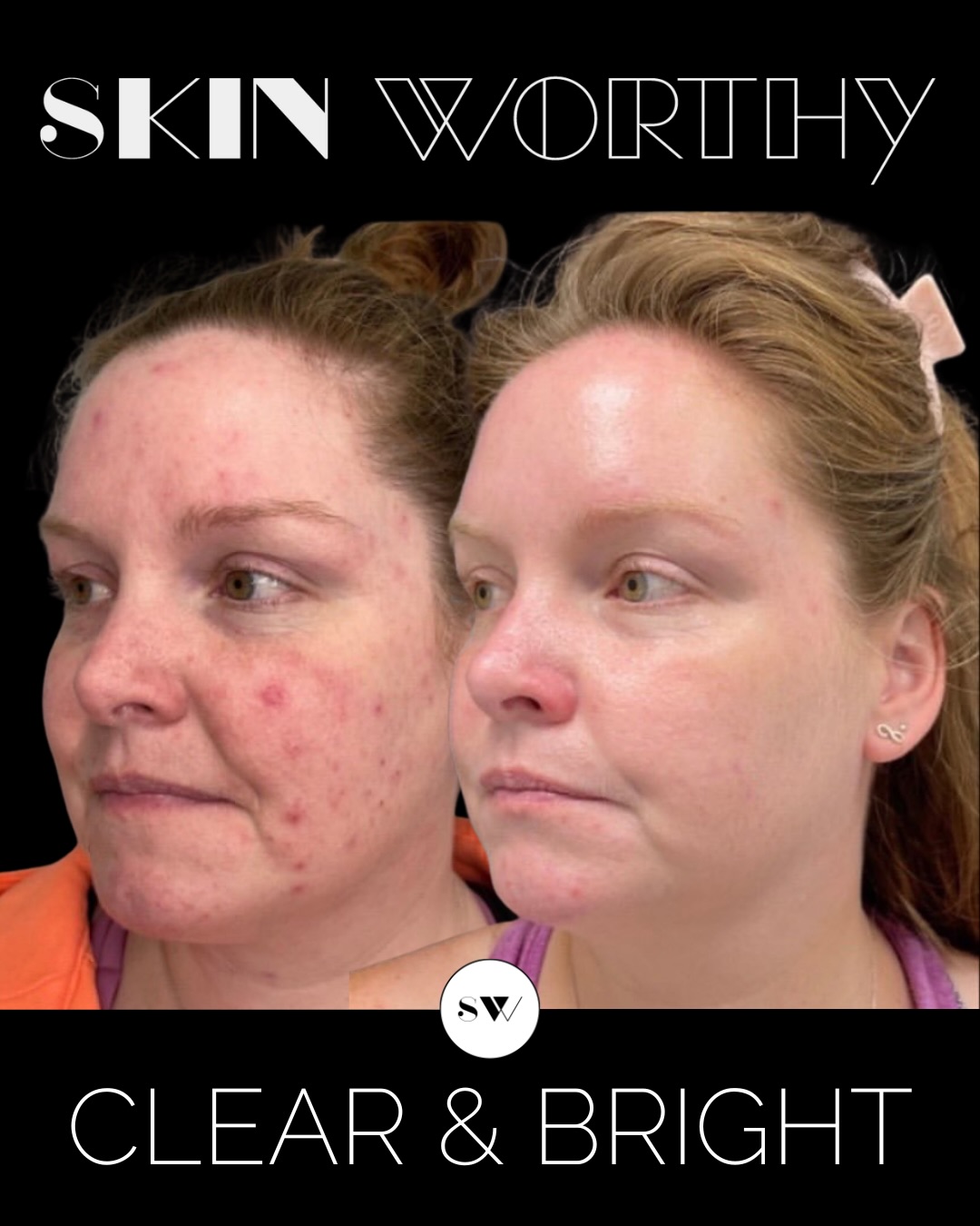 Red, reactive, inflamed skin?
Our Clear + Bright treatment package is designed to do more than just manage breakouts — it works to reset the skin.
This combination treatment helps:
• Deeply cleanse + clear congestion
• Target acne-causing bacteria
• Calm inflammation + reduce redness
• Support healing to minimize post-acne scarring
Because when it comes to acne and rosacea, consistency isn’t optional — it’s what drives real results.
Ready to get your skin back on track?
DM us to learn more or text 647-350-7546