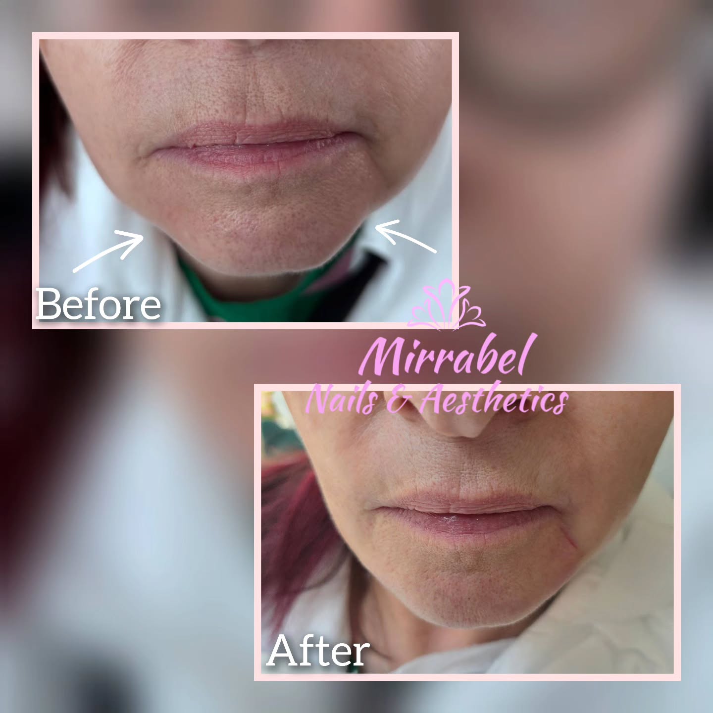 Sculpted, snatched, and effortlessly defined ✨
Jowls on point 💉💎
#JawlineFiller #AestheticResults #Snatched #FacialContour #GlowUp