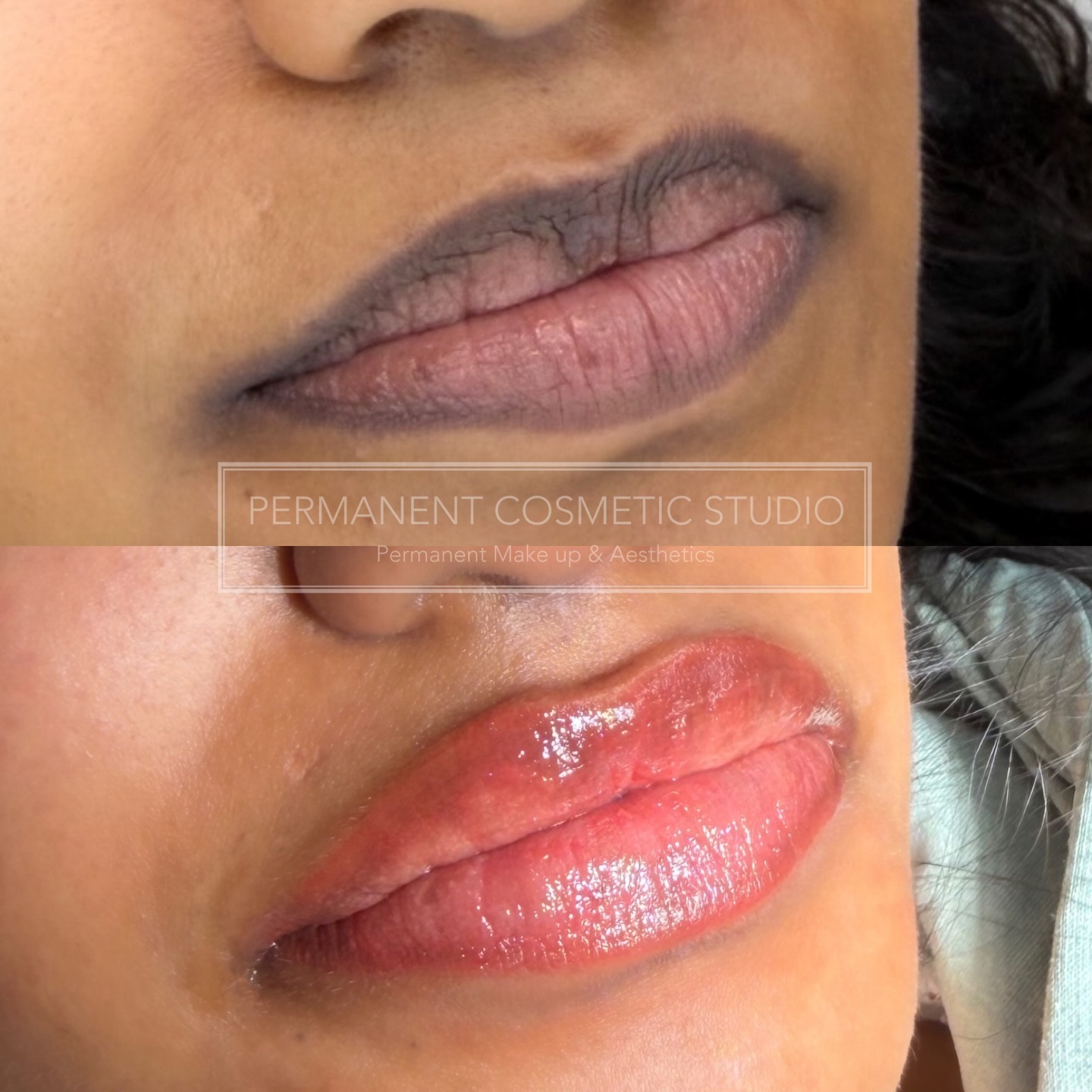 There’s something about a challenge that calls me… 🙌🙌 and dark lip neutralisation?
That’s where the real artistry lives
Not a one-shade-fits-all treatment
Not a quick fix
This is precision…
Layering…
Understanding undertones most people don’t even see.
Because these results aren’t just about colour…
they’re about confidence returning to your face in the most natural way 🍃
If you’ve been told “it’s too dark” or “it won’t take”…
come and sit in my chair.
✨ Specialist in dark lip neutralisation
✨ Bespoke pigment correction
✨ Healed, natural-looking results over time
📍Loughton
📩 DM “NEUTRALISE” to start your journey
.
.
.
#lipneutralisation #darklips #pmulips #lipblushuk #aestheticclinicuk