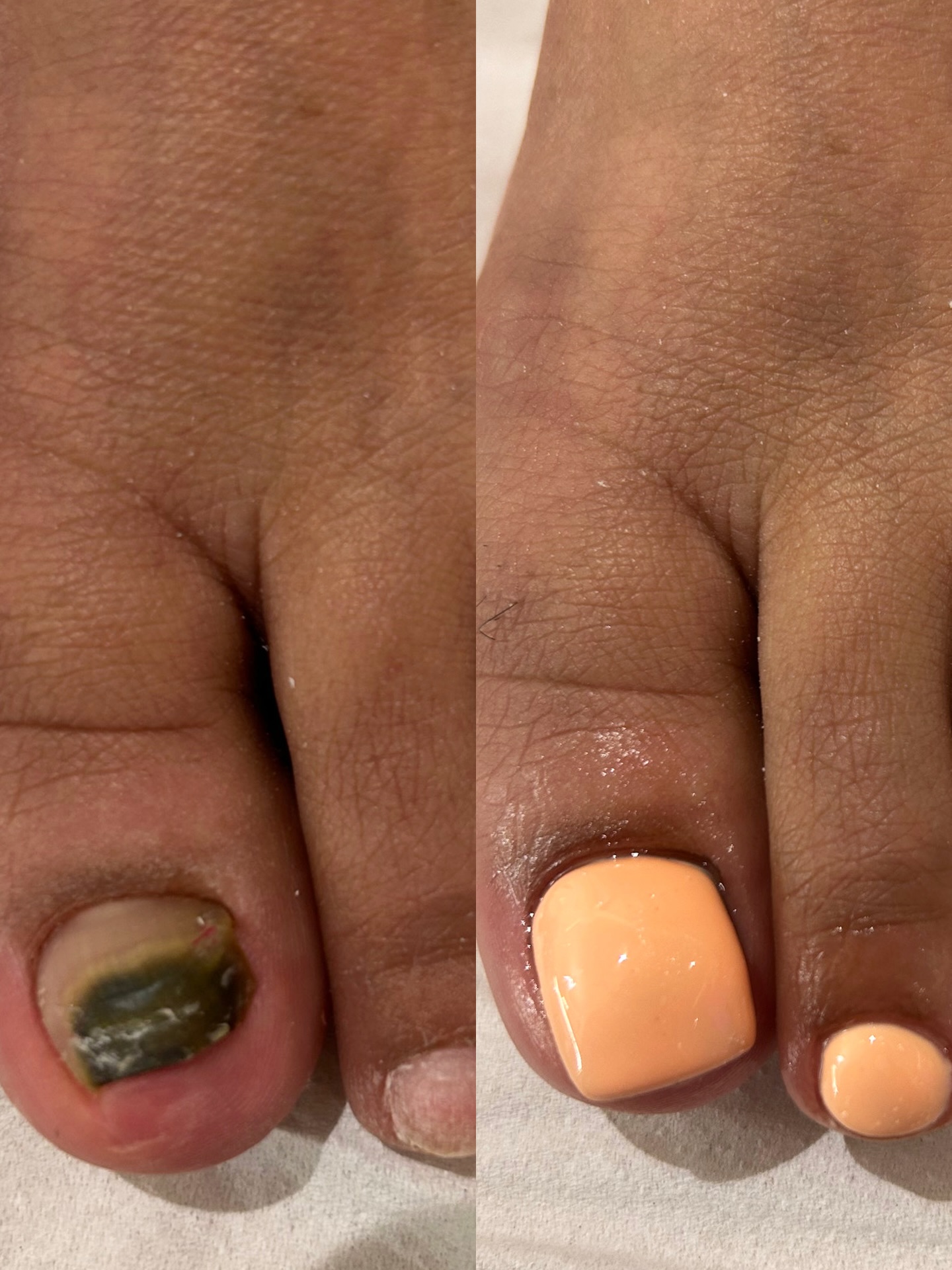 They don’t call us the toe nail queens for nothing 💁🏼♀️🙋🏽♀️
Toenail reconstruction rebuilds damaged or missing nails using breathable, anti-fungal, medical-grade products — protecting the nail bed and supporting healthy regrowth. Clean, precise, and natural-looking.
#TheGlowBarLDN #ToenailReconstruction #FootHealth #NailRestoration #ToeBBL