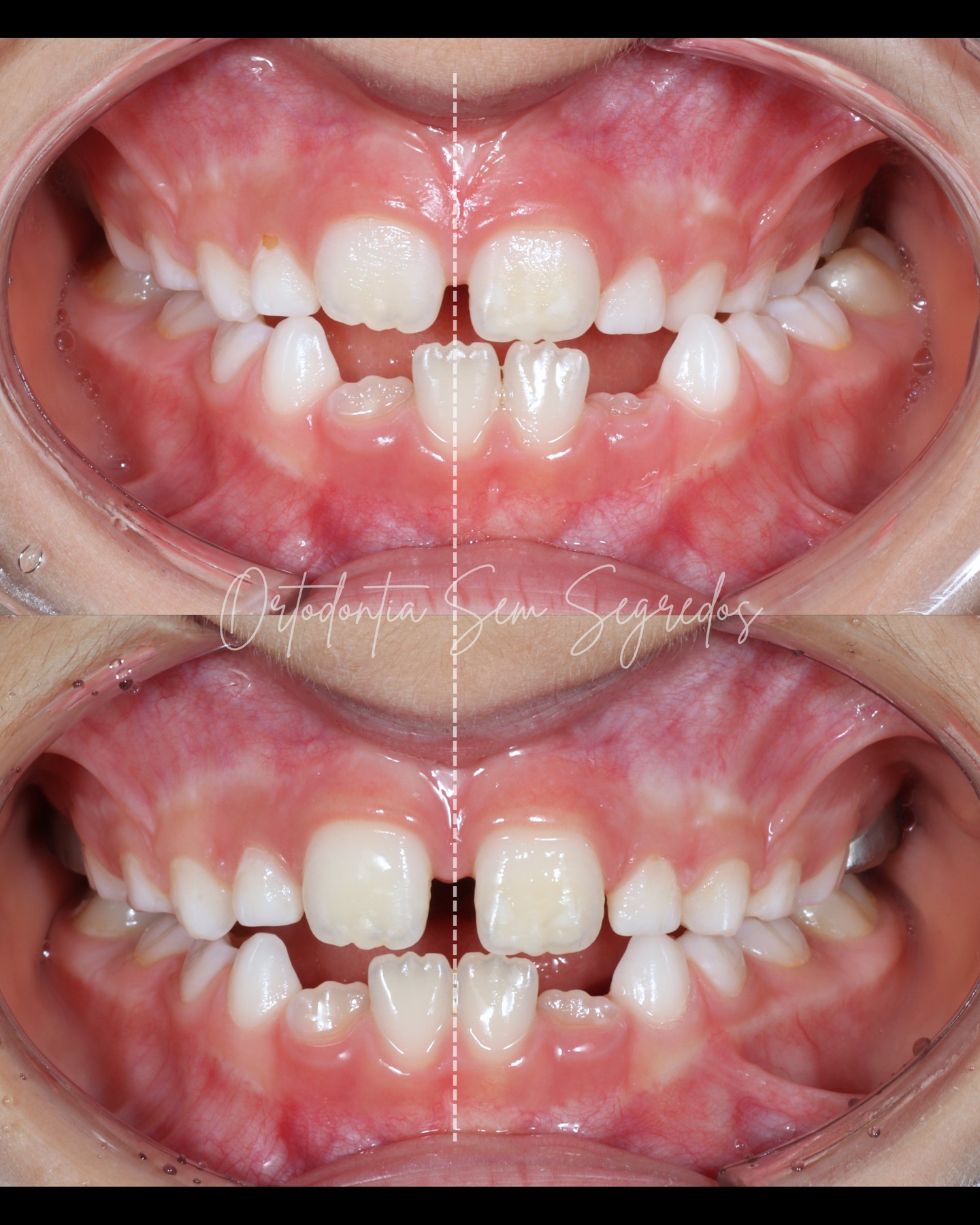 🦷 Intervir no momento certo pode mudar completamente o crescimento facial de uma criança.
Neste caso clínico, uma mordida cruzada posterior estava a provocar um desvio funcional da mandíbula.
Com uma intervenção precoce, através de disjunção maxilar com Hyrax, foi possível corrigir a mordida cruzada e recentrar a mandíbula, permitindo que o crescimento prosseguisse de forma mais equilibrada.
Se esta situação não tivesse sido tratada nesta fase, era muito provável que esta criança evoluísse para uma assimetria mandibular esquelética, com repercussões funcionais e estéticas muito mais complexas de corrigir no futuro.
É este o verdadeiro valor da ortodontia intercetiva:
👉 Identificar o problema cedo e intervir no momento certo para guiar o crescimento e evitar discrepâncias esqueléticas futuras.
Queres aprender a reconhecer estas oportunidades de intervenção e tratar crianças com mais segurança e previsibilidade?
📅 Curso de Ortodontia Infantil Sem Segredos
15 a 19 de junho de 2026
🔗 Mais informações no link da bio