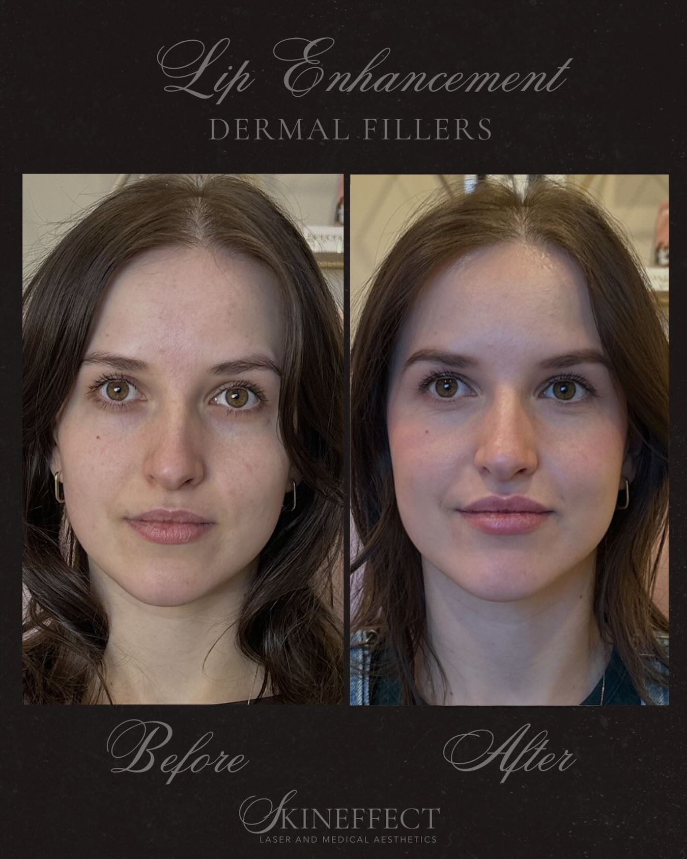 Soft, subtle, and beautifully enhanced 💋✨
A natural boost in volume and definition—because the best results still look like YOU, just a little more confident.
Before ➡️ After: hydrated, plumped, and perfectly balanced lips.
#medicalaesthetician #injector #medispa #yegmedispa #explorepages
•
•
•
{Edmonton Medi spa • Sherwood Park Medi Spa • Fort Saskatchewan Medi Spa • Yeg Medi spa • Medical Aesthetics • Nurse Injector • Botox • Dysport • Nuceiva • Fillers • Dermal Fillers • Chin Filler • Lip Filler • Cheek Filler • Chemical Peel • IPL • Hydrafacial • Morpheus8 • Forma • InMode • Alumier • SkinCeuticals • ZO • ColoreScience}