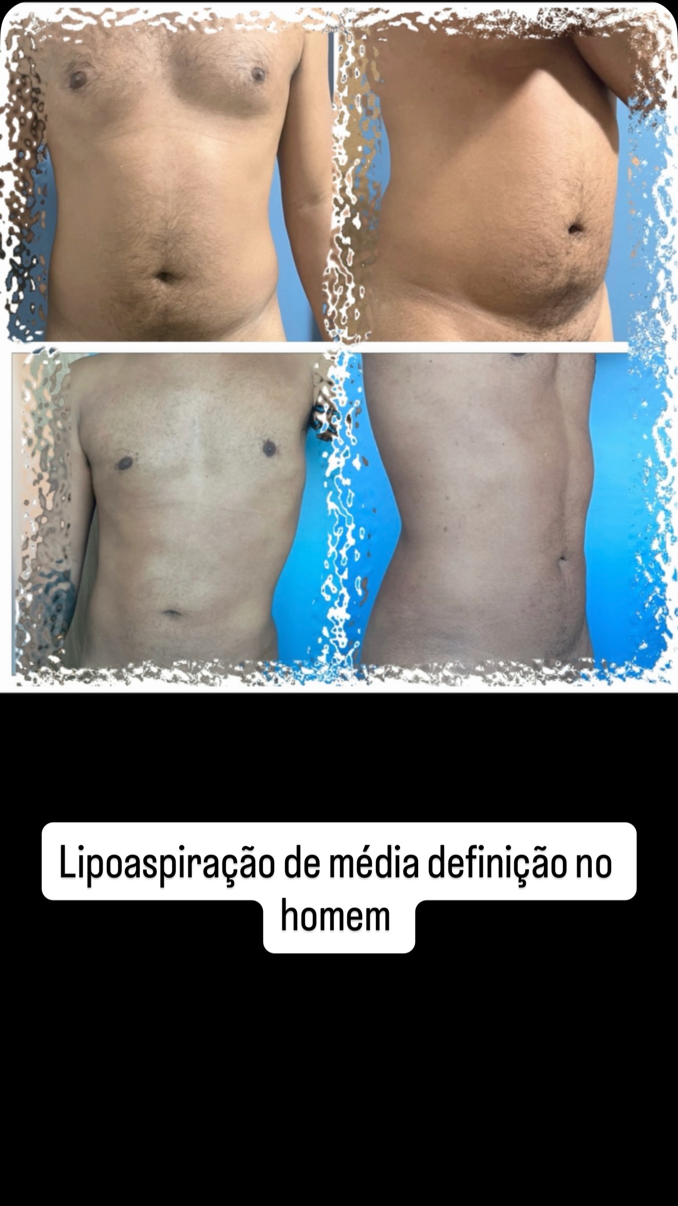 No homem, a lipo de média definição busca criar um contorno mais atlético e masculino, evidenciando abdome, cintura e peitoral de forma natural, sem exageros.
O objetivo não é deixar um aspecto artificial, mas sim dar a aparência de um corpo mais definido, forte e harmonioso, respeitando a anatomia de cada paciente.