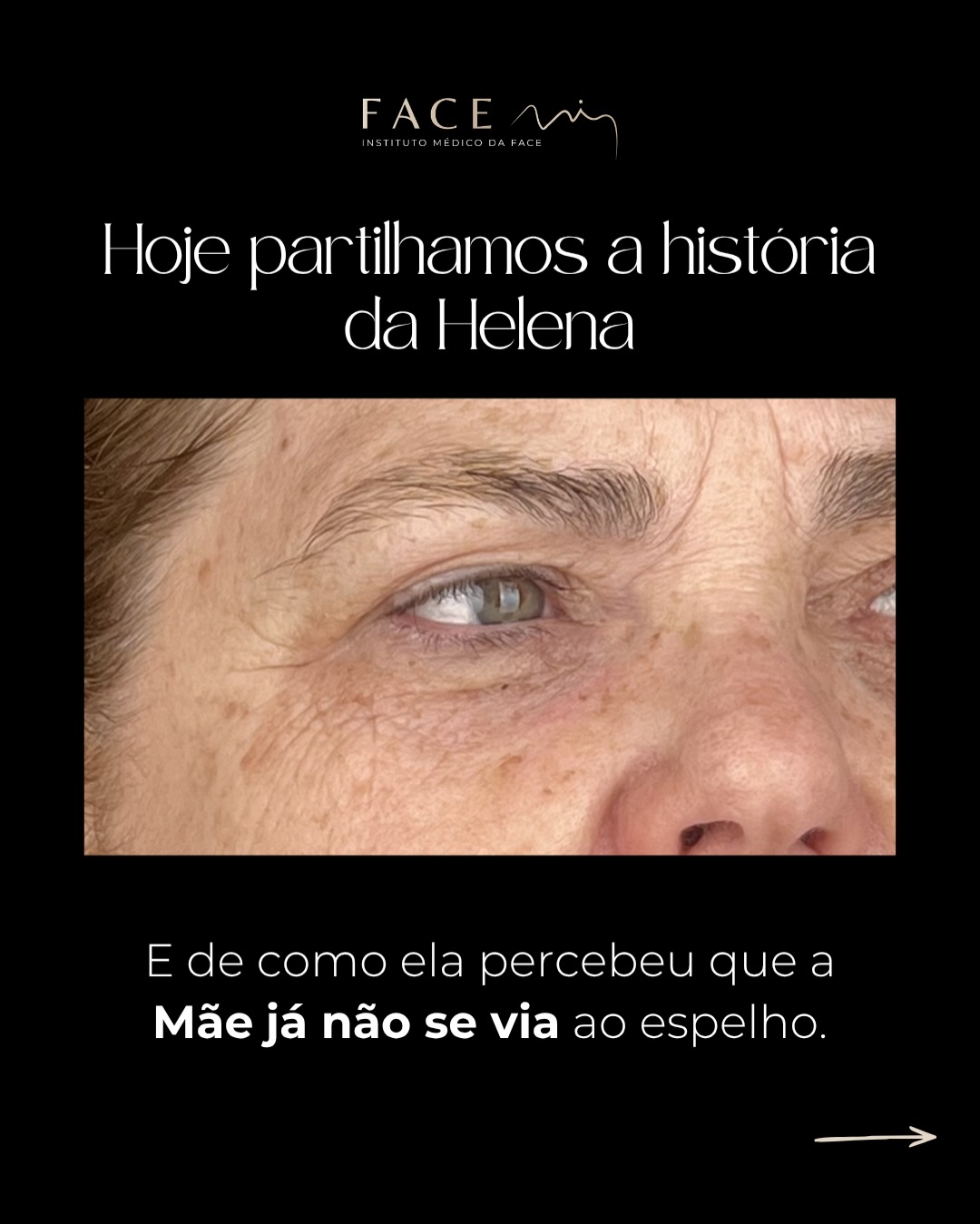 A mãe da Helena começou a deixar de se reconhecer ao espelho. Não era vaidade, era cansaço e uma imagem que não era a dela.
A Helena tomou a decisão de ajudar a mãe a sentir-se melhor e marcou consulta na Face Mi.
O plano foi simples: devolver a luminosidade e vitalidade sem transformar.
Neste Dia da Mãe homenageamos as mães, mas também os filhos e filhas que ajudam a devolver o brilho das mães ♥️