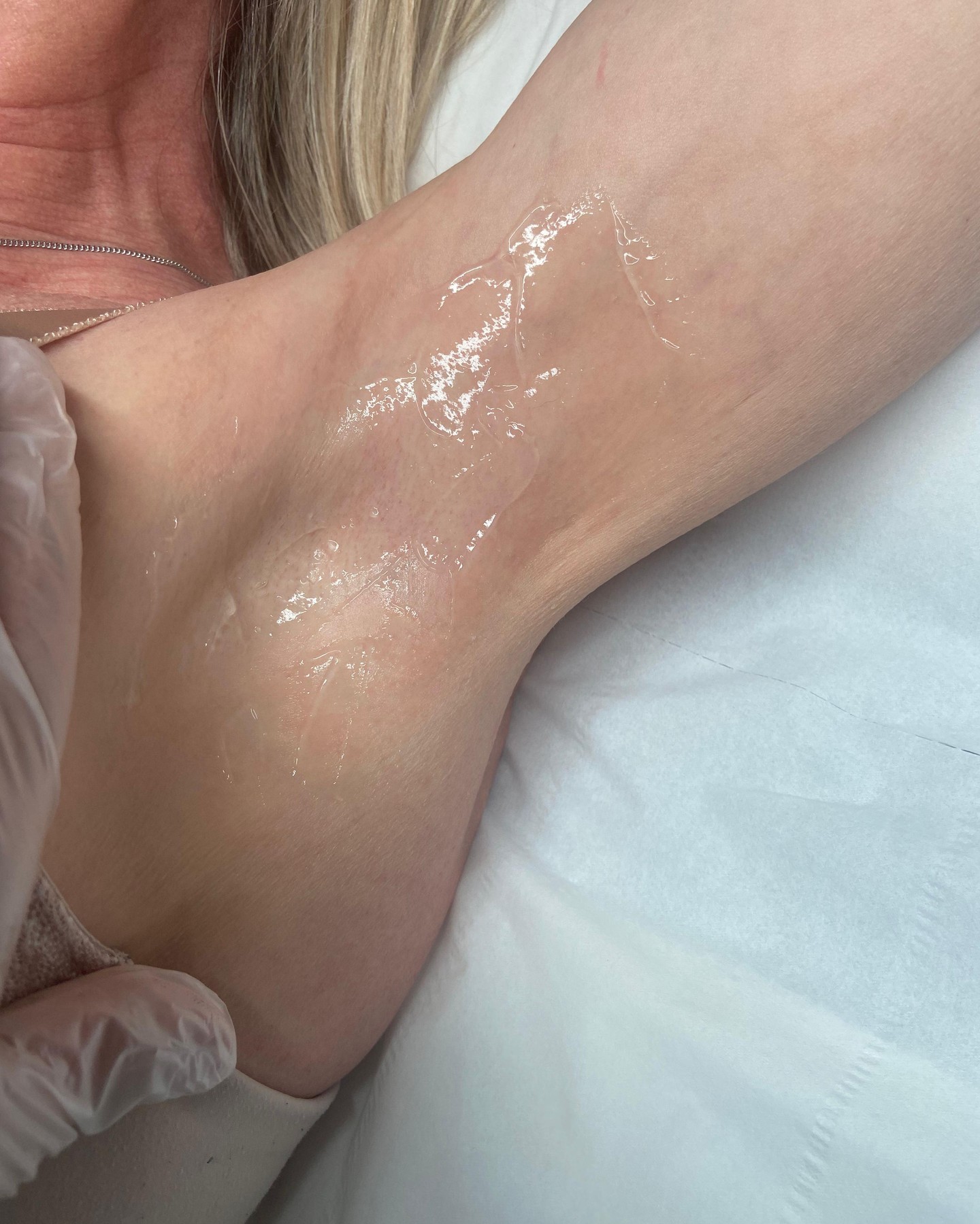 Six sessions. Silky smooth. Confidence unlocked.
Imagine underarms this clear and comfortable. No more shaving, no more stubble.
Ready for your own transformation? Book your consultation with Naz today. β¨
Naz xx
