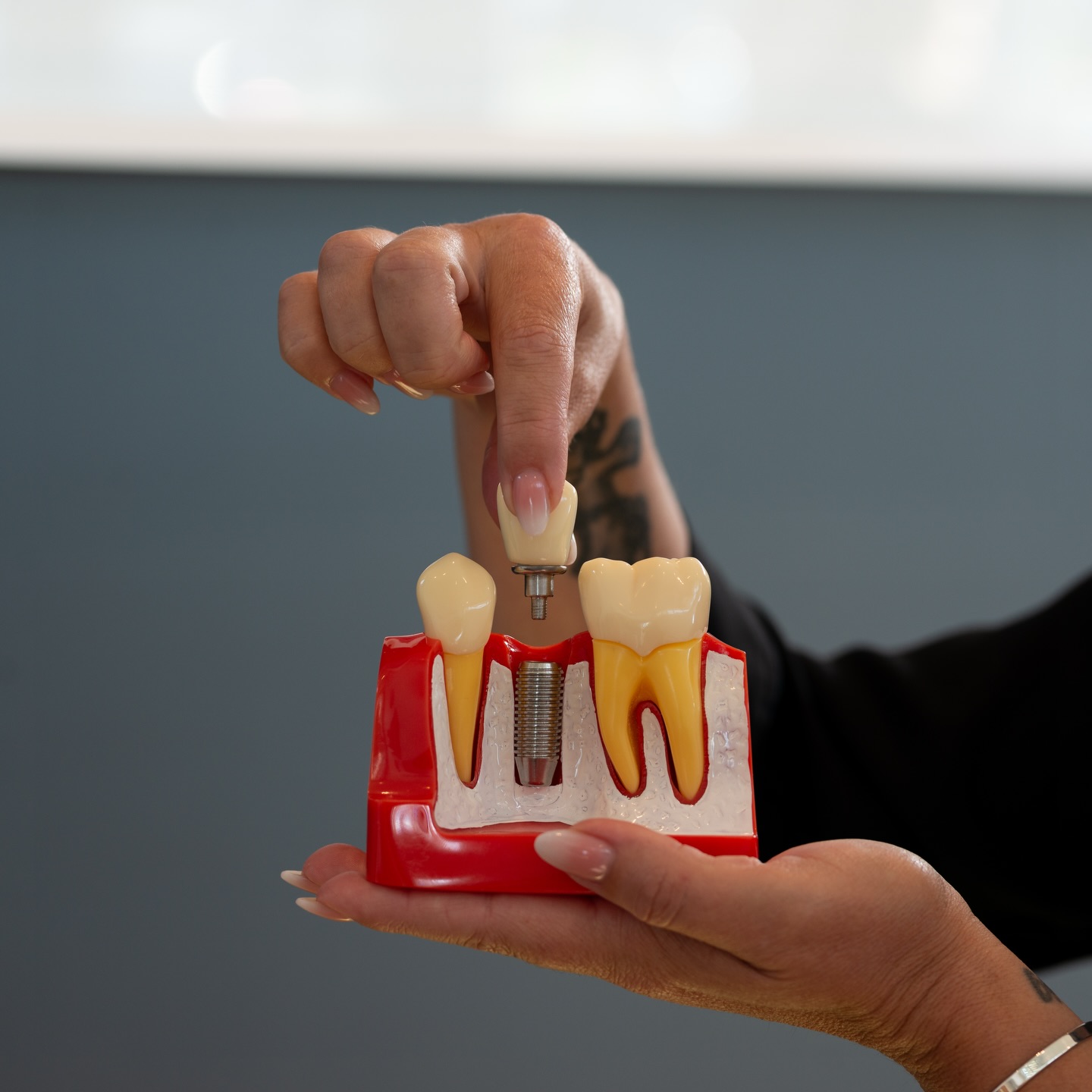 Restore your smile with confidence 🦷
Dental implants are a long-lasting solution for missing teeth, designed to look, feel and function just like natural teeth. They help maintain jawbone structure, prevent surrounding teeth from shifting and restore your ability to eat and speak comfortably.
With the right care, implants can last for many years, even a lifetime. Addressing missing teeth early supports your overall oral health and helps avoid future complications.
A reliable, natural-looking option to rebuild your smile, seamlessly blending in, so you can smile with ease again. 💙
#dentalplusnz