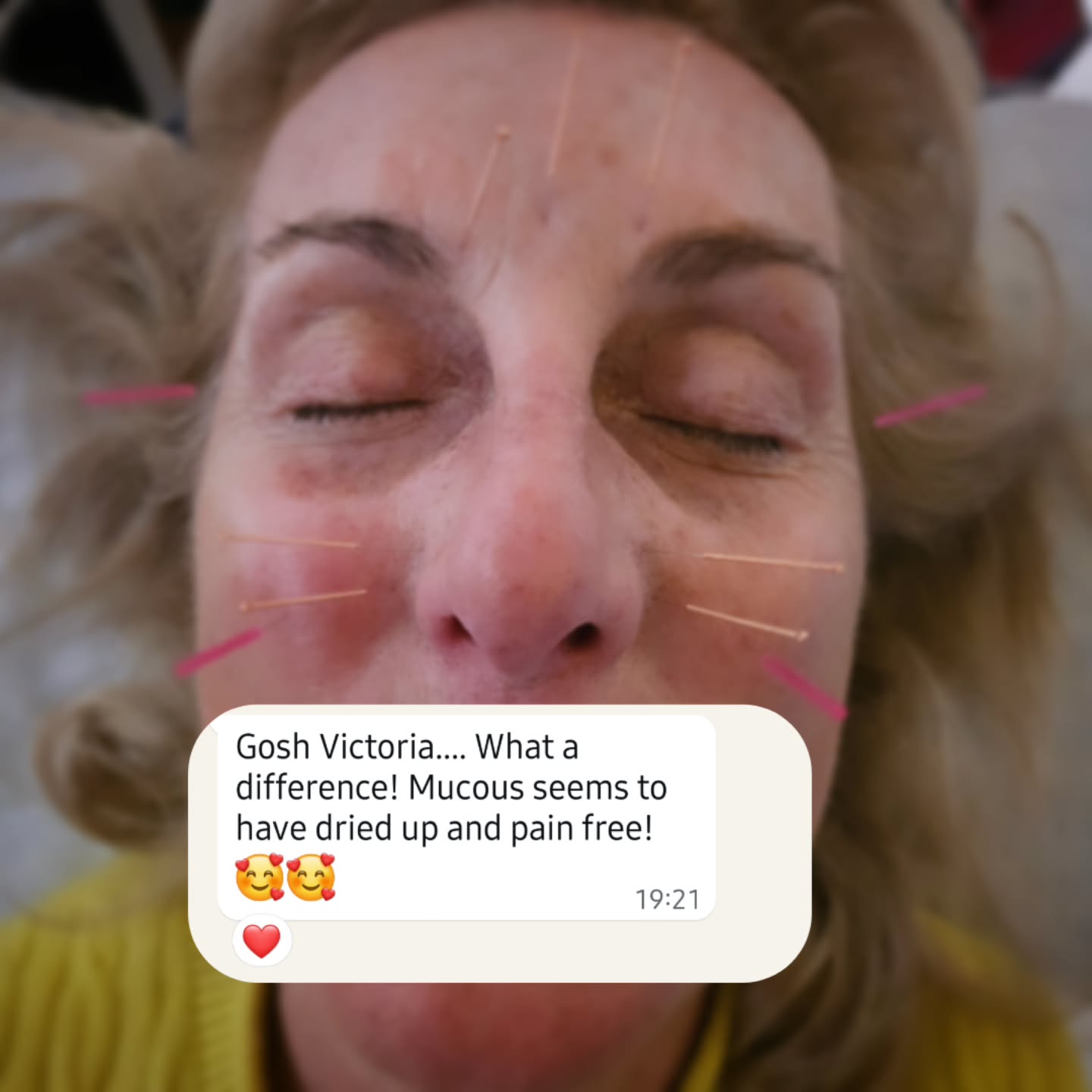 My client kindly allowed me to share a sneak peek of her treatment today, she's had terrible sinuses for weeks, painful, swollen and really blocked up. Today we used acupuncture and a little massage magic to drain and release, and the text message came from her 4 hours later. Love a successful treatment. #acupuncturistsofinstagram ##acupuncturetamworth #acupuncturist #sinus #takecontrolofyourwellbeing