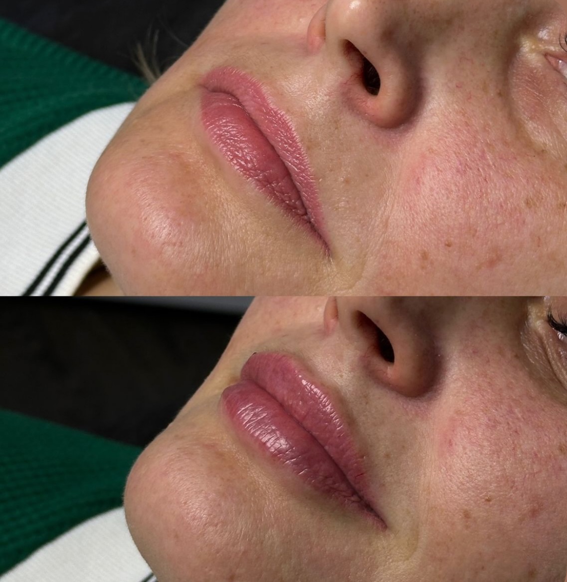 Thinking about lip filler? Here’s what matters:
It’s not about bigger lips — it’s about proportion, symmetry, and structure.
At Priory Medical we:
• Assess facial balance
• Use precise micro-dosing techniques
• Prioritise safety and long-term outcomes
Because lips should fit your face, not follow trends.
Book your consultation today #lipfiller #priorycentre
