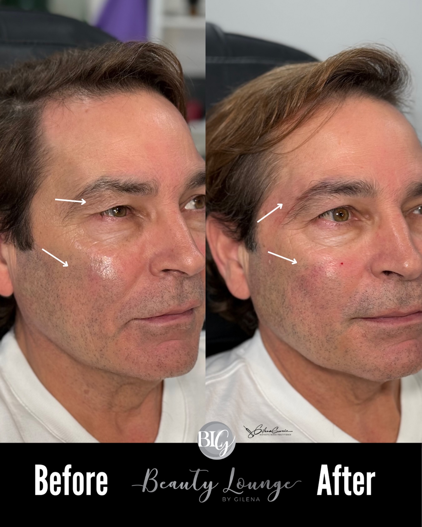 Not about “filling”…
it’s about repositioning, balancing, and restoring support where the face truly needs it.
In this case, we performed facial harmonization with @revanceaesthetics versa + hyaluronic acid filler to restore lost volume and improve the under-eye area 👁️
The result:
✔️ A more rested, refreshed look
✔️ Smoother transition between the eye and cheek
✔️ Improved skin quality and projection
All done with a prior medical evaluation, precise technique, and a focus on natural results 🤍 🇻🇪No se trata de “rellenar”…
se trata de reposicionar, equilibrar y devolver soporte donde el rostro lo necesita.
En este caso trabajamos armonización facial con ácido hialurónico Revanesse para devolver volumen perdido y corregir la zona periocular 👁️
El resultado:
✔️ Mirada más descansada
✔️ Transición más suave entre ojo y mejilla
✔️ Piel con mejor calidad y proyección
Todo realizado con evaluación médica previa, técnica precisa y enfoque en resultados naturales 🤍
📩 DM “gratis” para tu evaluación
📩 DM “FREE” for your evaluation
📍 Miami | Hallandale