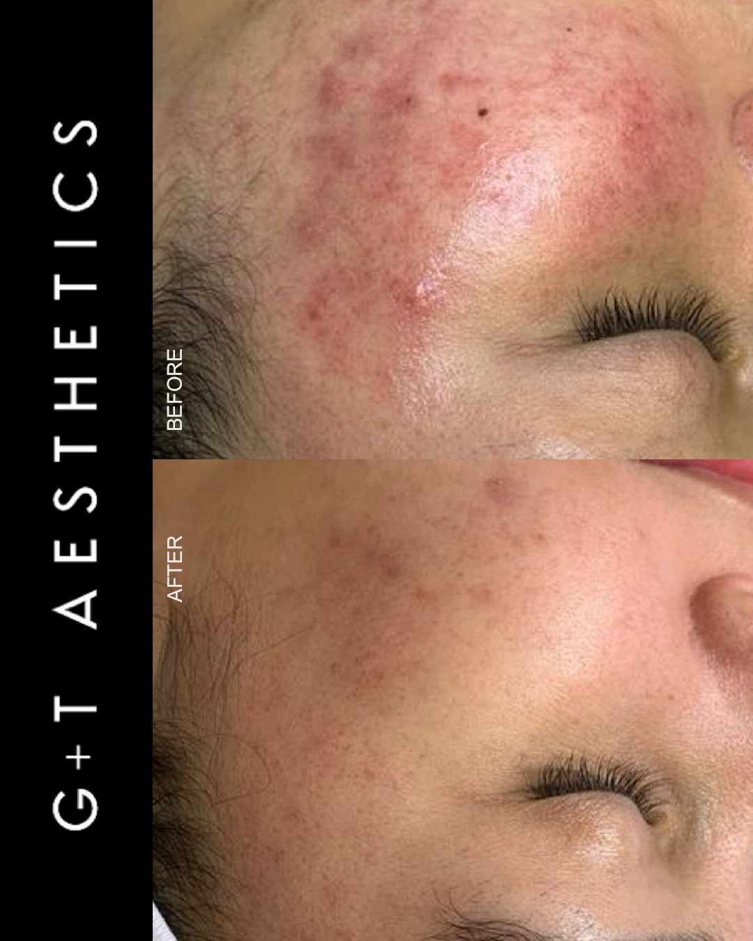Deep pore extraction is designed to remove congestion and impurities from within the skin. These results highlight a clearer, more refined complexion following treatment.
📲Enquire or visit www.gtaesthetics.co.uk for more info.
#DeepPoreExtraction #ClearSkin #FacialTreatment #BeforeAndAfter #SkinHealth #StamfordAesthetics #GTAesthetics