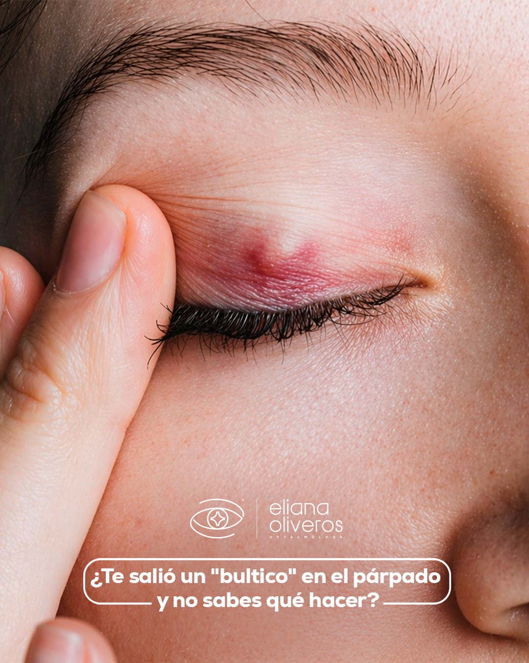 Despertar con un “bultito” en el ojo es molesto y a veces hasta asusta, pero la mayoría de las veces tiene una solución clínica muy sencilla 😄👇
Ya sea un orzuelo o un chalazión, la clave está en la higiene y el calor suave ❌ Nada de remedios de internet extraños y, sobre todo, NADA de intentar reventarlo frente al espejo❌
Si lo haces, podrías causarte una infección mucho más grave en los tejidos del párpado 😳
Si llevas días con él y no mejora con compresas tibias, escríbenos al enlace del perfil para darte el tratamiento médico adecuado en gotas o ungüentos. 👩⚕️👨⚕️