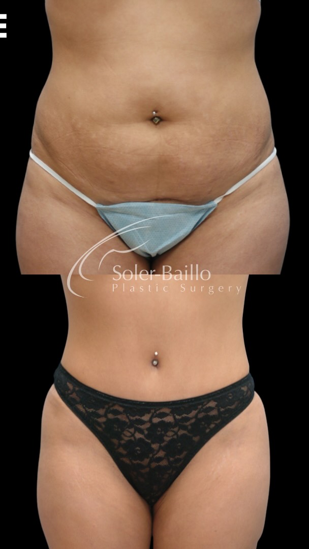 Where precision meets artistry 👨🏻⚕️ a refined approach to abdominal contouring. ✨
The Bikini Tummy Tuck™ Technique has been one of Dr. Soler-Baillo’s signature procedures since 2002, an original method designed for sculpted, natural-looking results with a discreet, bikini-friendly scar. 👙
This transformation also included muscle repair (plication) to restore core integrity and enhance a flatter, more defined silhouette.
💫 Real patient transformation�✔️ Flatter, tighter abdomen�✔️ Sculpted, feminine waistline�✔️ Muscle repair for improved contour�✔️ Low, concealed incision placement�✔️ Elegant, natural results
For those seeking a more elevated alternative to the traditional tummy tuck, this technique is designed with both structure and aesthetics in mind.
📍Coral Gables
🗓️ Schedule your private consultation today!
(305) 661-1996 #plasticsurgerymiami #tummytuck #bikinibodyguide #musclerepair #drsolerbaillo