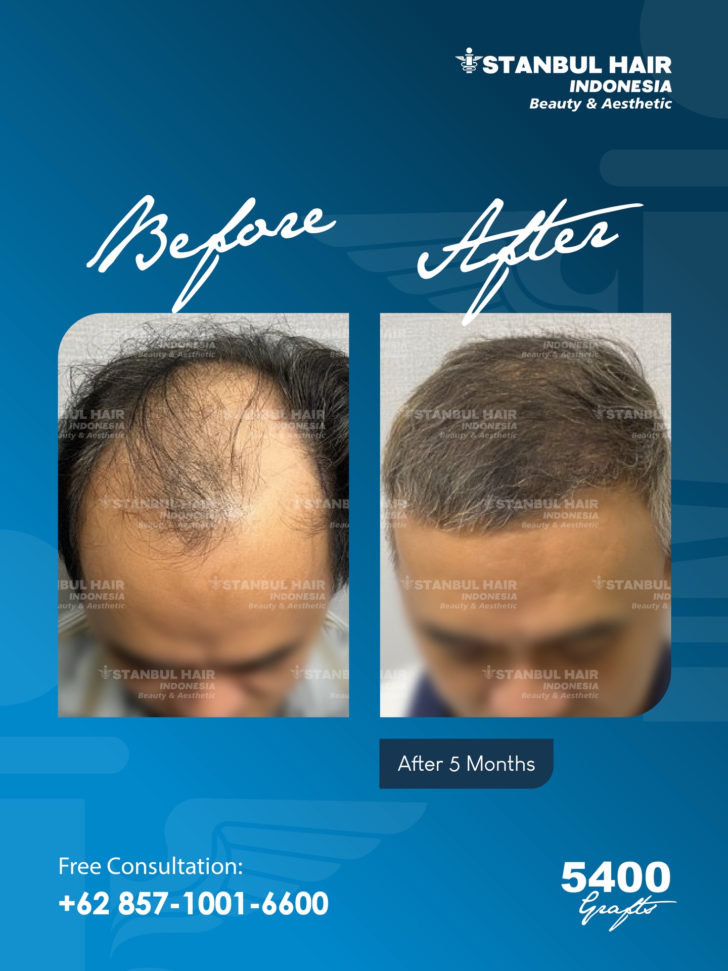 Hasil 5 bulan pasca hair transplant dengan 5400 grafts (teknik hybrid).
Area yang sebelumnya menipis kini terisi lebih padat dengan hasil yang tetap natural.
Progres nyata, ditangani dengan teknik yang tepat. ✨
Konsultasi GRATIS tersedia untuk Anda.
—
5-month result after a 5400 grafts hybrid hair transplant.
Thinning areas now show improved density with a natural finish.
Real progress, driven by the right technique. ✨
Free consultation available.
#HairTransplantHybrid #5400Grafts #NaturalHairResult #HairRestoration #BeforeAfter