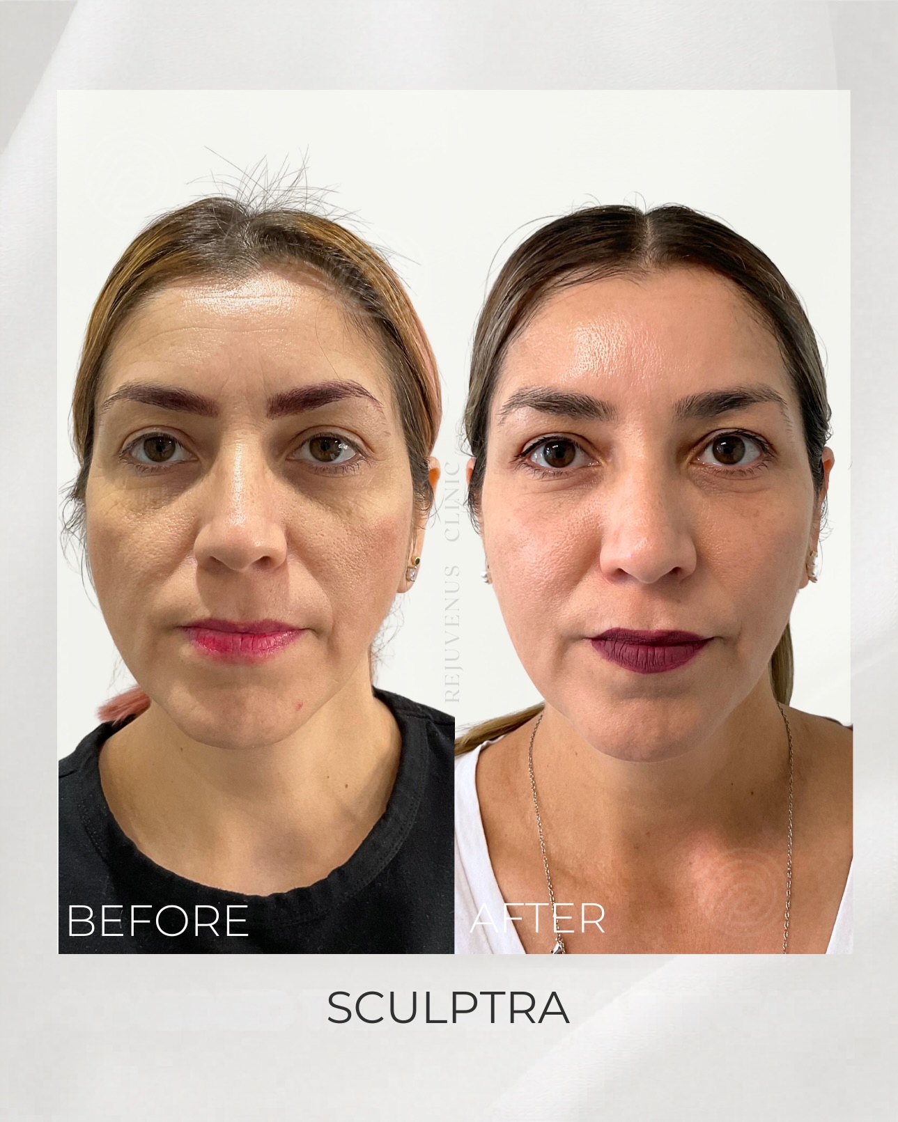 The long game looks good on you. 🙌✨
Sculptra works deep beneath the surface to gradually rebuild collagen, restore volume, and smooth skin over time-so results look subtle, sculpted, and entirely your own.
This before + after shows what happens when you blend precision, experience, and a deep understanding of facial harmony. Our medical injectors approach is simple: enhance what’s already there.
Perfect for:
- Softening smile lines + hollowness
- Subtle contour + lift
- Strengthening skin from within
Want to learn more? Let’s create your refresh plan-designed just for you. 💫 This is your moment to invest in skin that keeps getting better. 🌟 Book your next appointment and step into spring with a fresh and rejuvenated glow! 💫🤩
𝐂𝐨𝐧𝐭𝐚𝐜𝐭:
📞 647.615.0223
📲: info@rejuvenusclinic.ca
🖥: www.rejuvenusclinic.ca
📍3130 Bathurst St, Toronto
🔗:WhatsApp ⤵️
https://wa.me/message/ZLBZ7RB3PVMZM1
.
.
.⠀⠀⠀⠀⠀⠀⠀⠀⠀
#rejuvenus #rejuvenusclinic #rejuvenusclinicca #sculptratoronto #sculptra prptoronto facialstoronto facialrejuvenation toronto smilelines nasolabialfolds marionettelines lips lipfiller lipflip lipaugmentation cupidsbow lipinjections facecontour chinfiller jawlinecontour explorepage sculptra sculptrafacelift