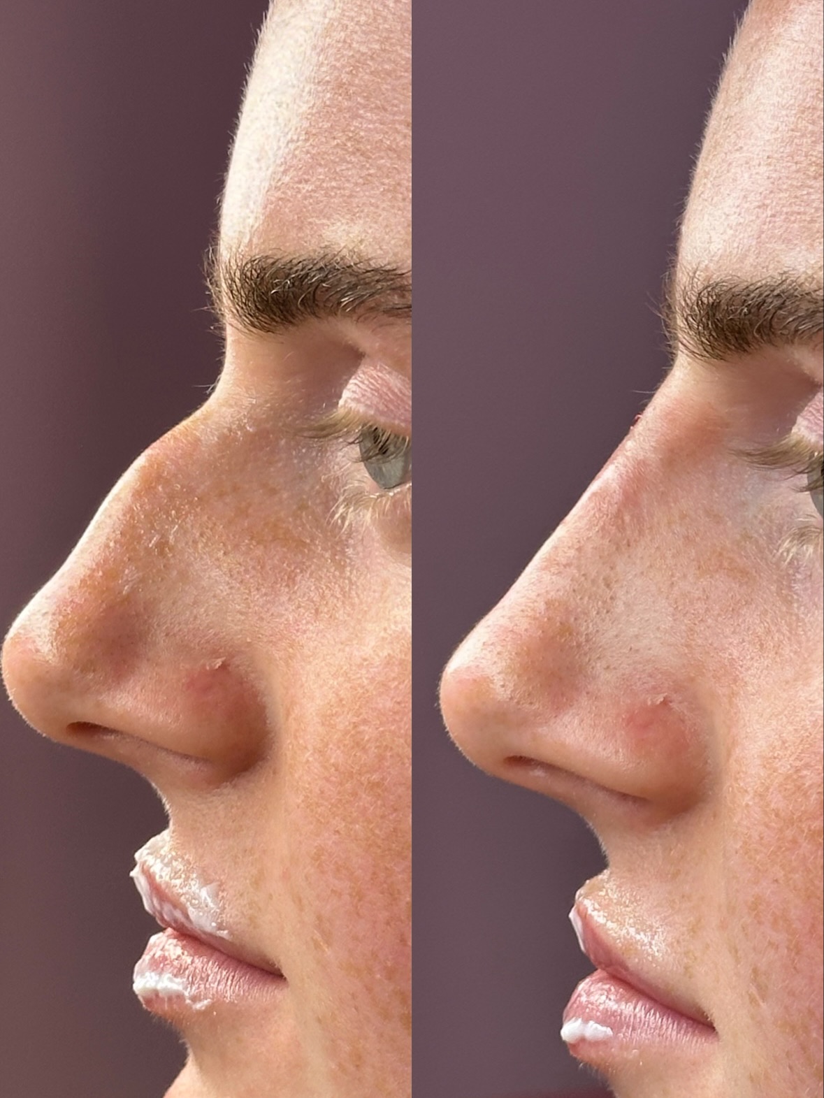 Ready for a nose transformation without the surgery 🧚
£5000 for surgery OR £240 for subtle, sculpted results in 30minutes?
Non surgical rhinoplasty using advanced filler techniques - no downtime, no scalpel just an instant result.
Perfect for softening bumps & rebalancing the side profile ✨
📍 Essex, @_allglowedup
📱 DM to book in for your free consultation today
#nosefiller #newnose #beforeandaftertransformation #nonsurgicalnosejob #explore