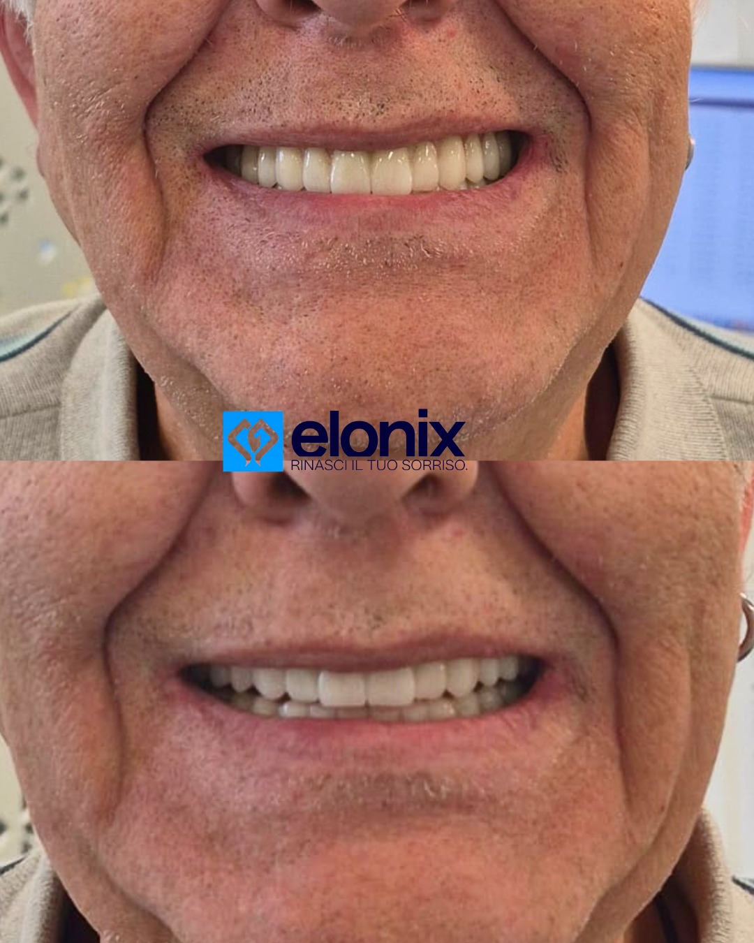 #elonix #elonixdentalclinic #elonixclinic #chiurgiamaxillofacciale #elonix #elonixdentalclinic #elonixclinic #chiurgiamaxillofacciale #clinica #elonix #estetica #salute #denti #dentista #impianti #turismodentale #turismodentalealbania #turismodentaletirana #turismodentaletiranaalbania #zircone #tirana #dentalsurgery #dentalveneers #dentalwork #laboratoriodentale #panoramica #scaner3d🦷 #dentifissi #sorriso #dentalsolutionsisrael #dentistica #sorridere
