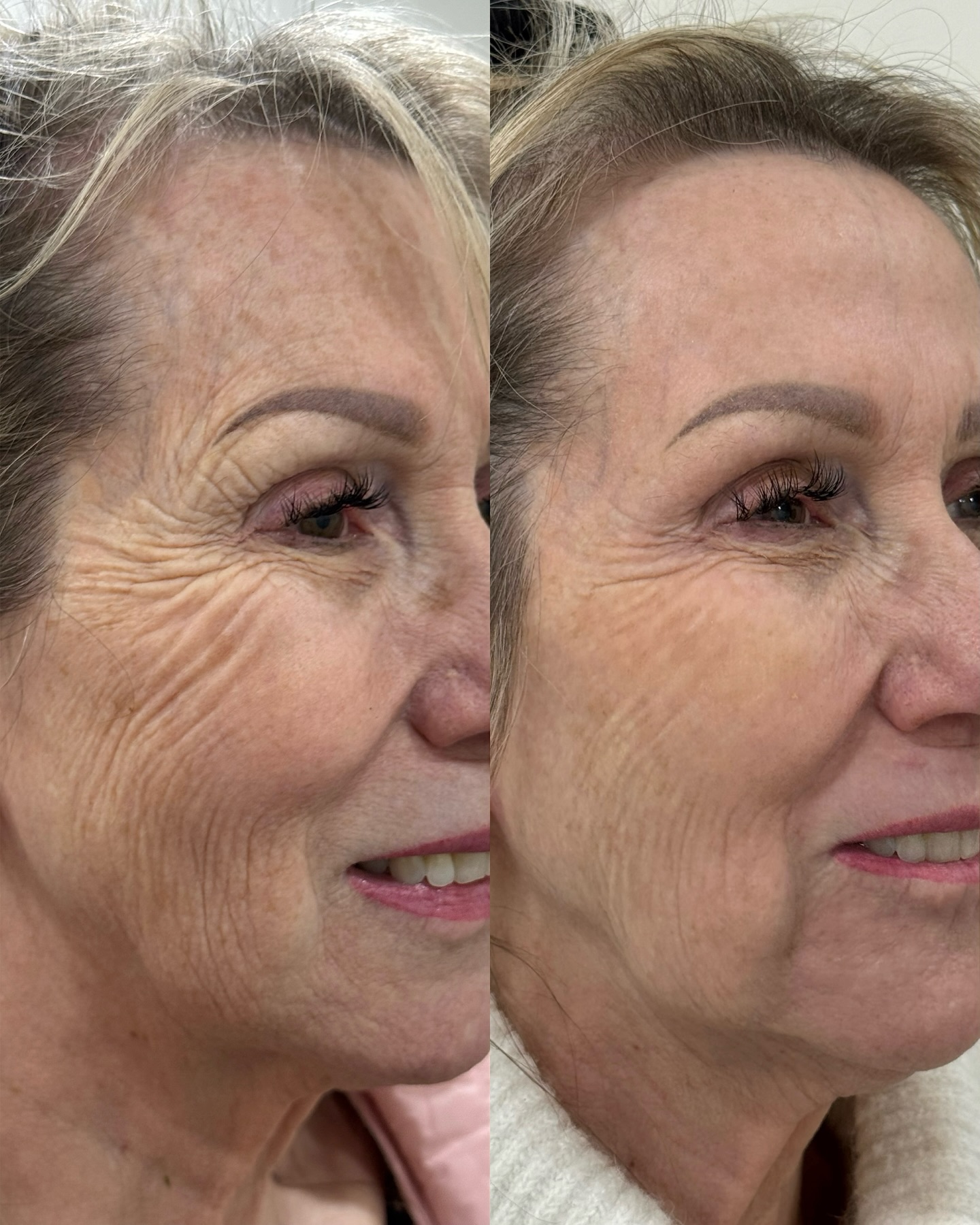 Transform your skin from within with the power of the DEKA CO₂ laser ✨
The DEKA CO₂ laser works by creating controlled micro-injuries in the skin to stimulate your body’s natural healing response and collagen production. This helps improve:
• Fine lines + wrinkles
• Acne scars + texture
• Sun damage + pigmentation
• Skin laxity
• Enlarged pores
• Overall skin tone + glow
With customizable settings like CoolPeel® or deeper resurfacing, treatments can be tailored to your skin goals and downtime preferences. As collagen remodels over the following weeks and months, skin appears firmer, smoother, tighter, and more refreshed.
Healthy skin is built from the inside out 🤍
#DEKACO2 #CoolPeel #SkinResurfacing #CollagenStimulation #ottawa
