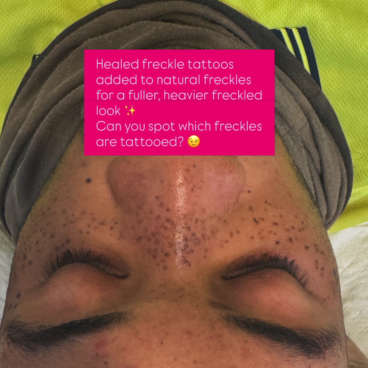 Not your usual soft natural freckle look 👀✨
This client wanted a heavier, more visible freckle style — bold, textured and full of character.
I usually create very natural and subtle freckles, so it was actually really fun to do something different, especially for a male client 🙌
All freckles are fully healed here… can you spot which ones are tattooed? 😉
#freckletattoo #boldfreckles #fauxfreckles #cosmetictattoo #healedresults mensstyle freckleartist perthbeauty tattooedfreckles spiralperth alternativebeauty