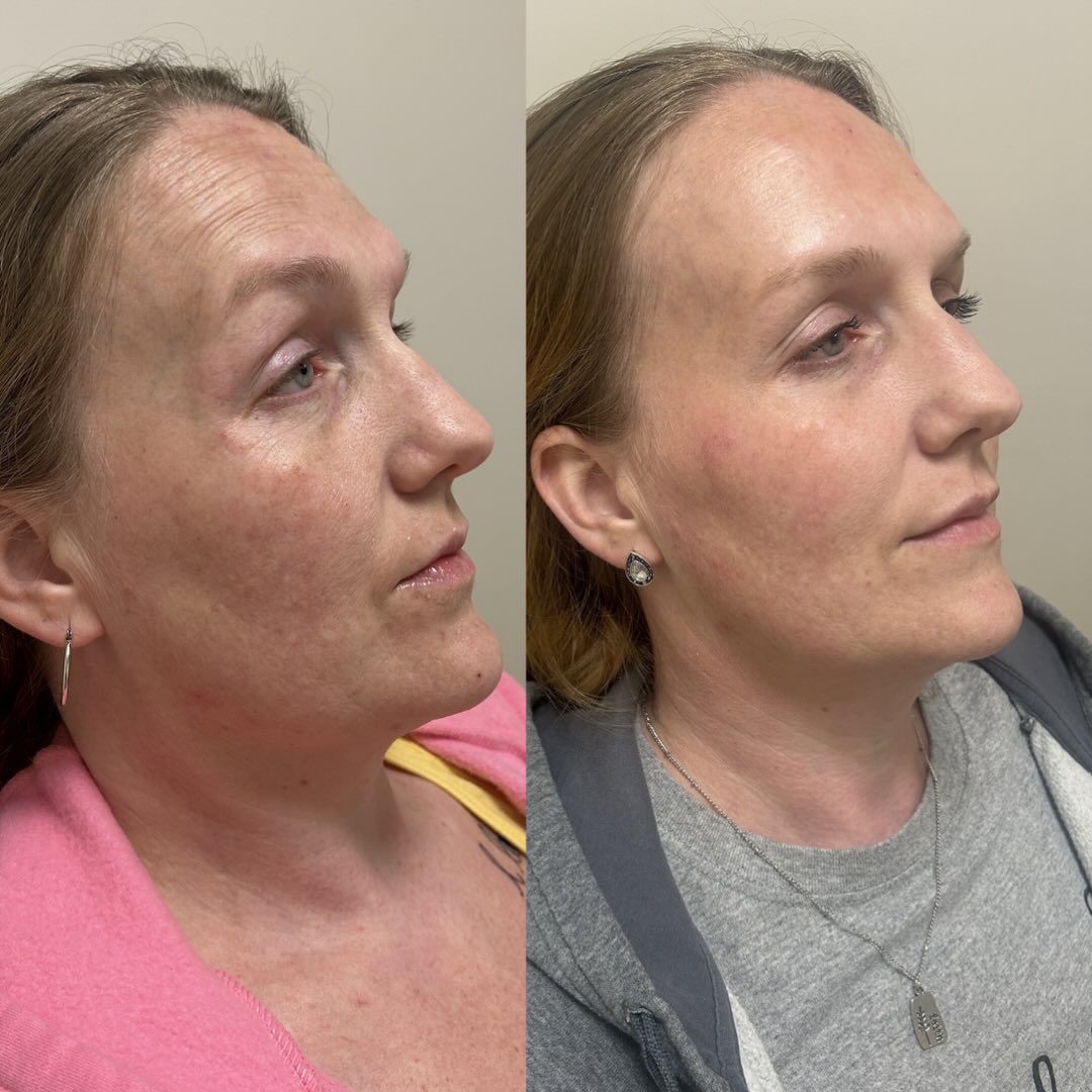 Letās talk about the truth about aging⦠because this is where people get it wrong šš¼
You cannot treat aging in one appointment.
And you definitely canāt treat it with just one thing.
This is 3 weeks difference.
What we did:
ā Midface filler for structural support (this is what actually lifts and softens everything below it)
ā Upper face tox to smooth and relax those deeper lines
ā Consistent skincare at home to improve overall skin quality
And this is already the result⦠in just a few weeks.
But hereās the part no one wants to hear:
⨠It takes time
⨠It takes consistency
⨠It takes multiple modalities
This is no different than weight lossā¦
You canāt go to the gym once a week, eat whatever you want, and expect a completely different body.
You need a plan. You need consistency. You need to stack the right things together.
Same with your face.
The best results come from:
ā Building structure (filler)
ā Relaxing movement (tox)
ā Improving skin (medical-grade skincare, treatments)
Not overdoing one⦠but strategically layering all of them over time.
And weāre not even done yet. We have a plan in place for her next visits.
Thatās how you get results that look natural, refreshed, and not ādone.ā
If youāre waiting for a one-time fix⦠this isnāt it.
If you want long-term results that actually age well⦠thatās exactly what we do here š¤