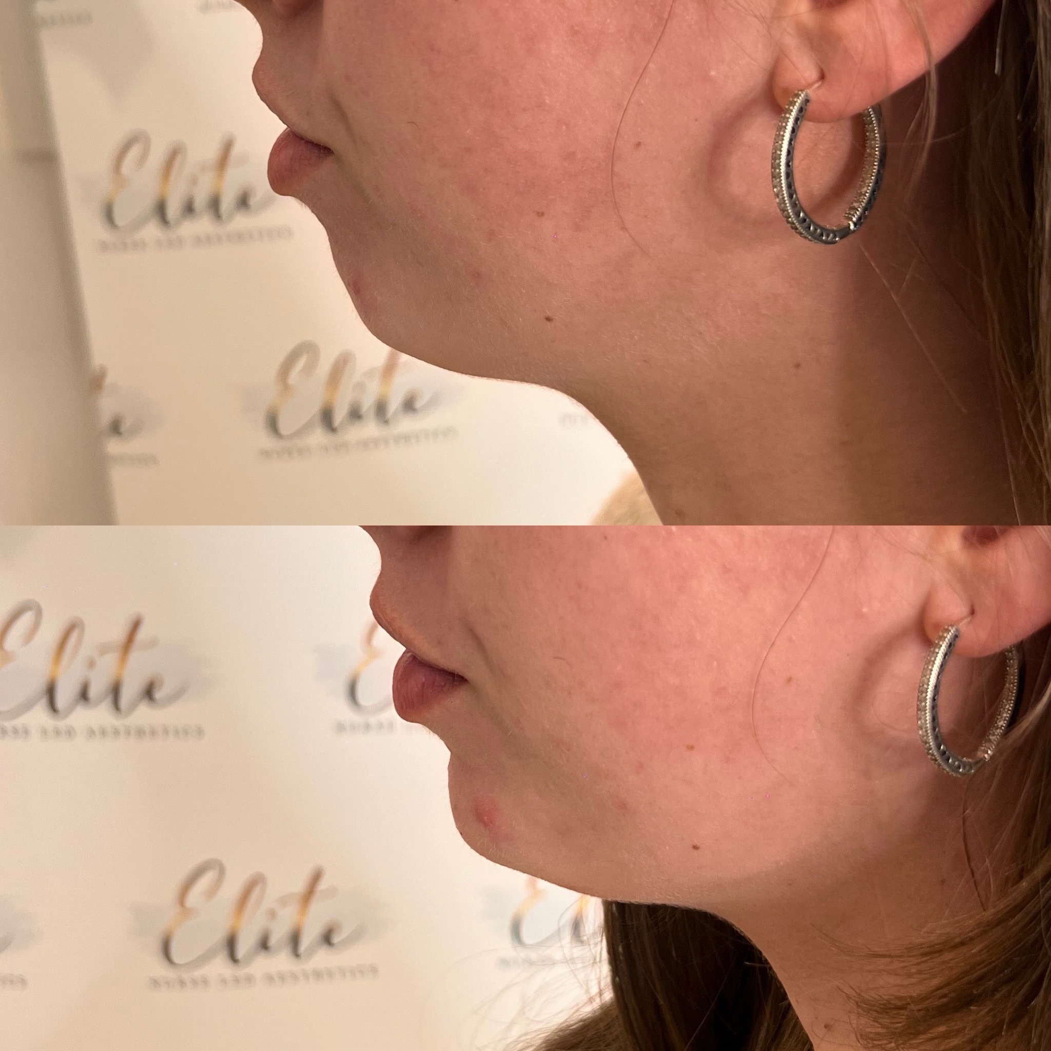 The secret to a balanced profile? It might be your chin… 👀✨
Chin filler isn’t about making your chin bigger — it’s about creating harmony across your whole face 🤍
With subtle, strategic placement, chin filler can:
✨ Improve side profile balance
✨ Enhance jawline definition
✨ Create better proportions between nose, lips & chin
✨ Strengthen a weaker chin
✨ Give a more sculpted, refined look
Sometimes the smallest tweak makes the biggest difference — especially from the side view ✨
At Elite Nurse Led Aesthetics in Wakefield, we specialise in natural, balanced results tailored to your unique features 🤍
Curious what chin filler could do for your profile?
DM now to book your consultation and let’s create your perfect balance ✨
#EliteAesthetics #WakefieldAesthetics #ChinFiller #ProfileBalancing FacialHarmony