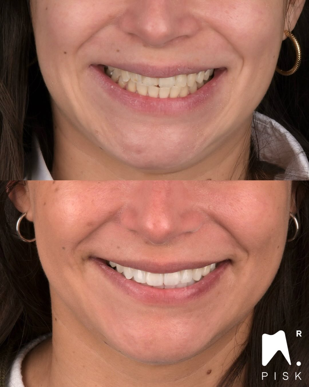 ORTHO and LAYERING & INJECTION
You want to learn how to do that ? @formation_dentaire_hdf