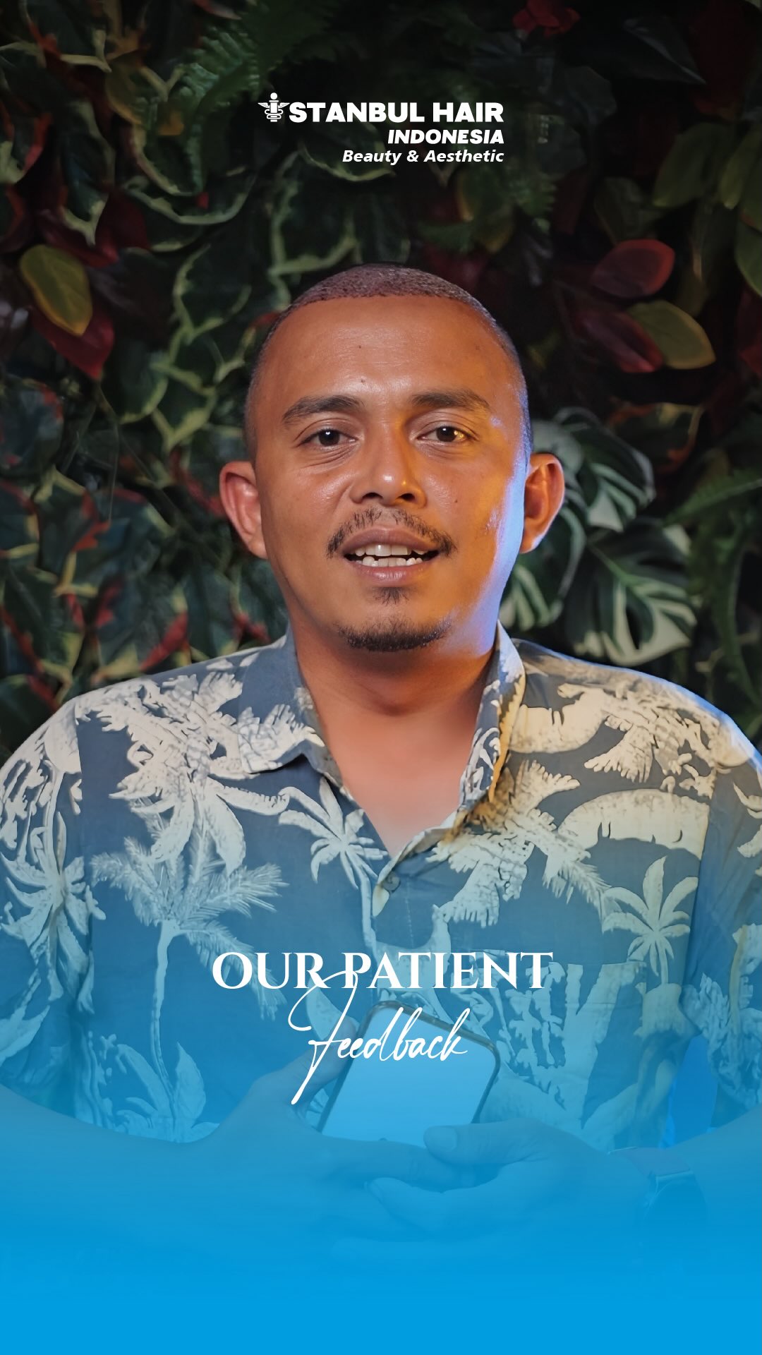Day 3 post hair transplant — belum soal hasil, ini soal awal yang tepat.
3000 grafts dari Palembang 🇮🇩 ke Jakarta.
Masih fase recovery, tapi fondasi hairline sudah terbentuk dengan rapi dan presisi.
Karena hasil besar selalu dimulai dari langkah pertama yang benar ✨
—
Day 3 after hair transplant — it’s not about results yet, it’s about the right start.
3000 grafts from Palembang 🇮🇩 to Jakarta.
Still in recovery phase, but the foundation is set clean and precise.
Great results always begin with the right first step ✨
#HairTransplantIndonesia #FUEIndonesia #HairJourney #Day3HT #FutureResult