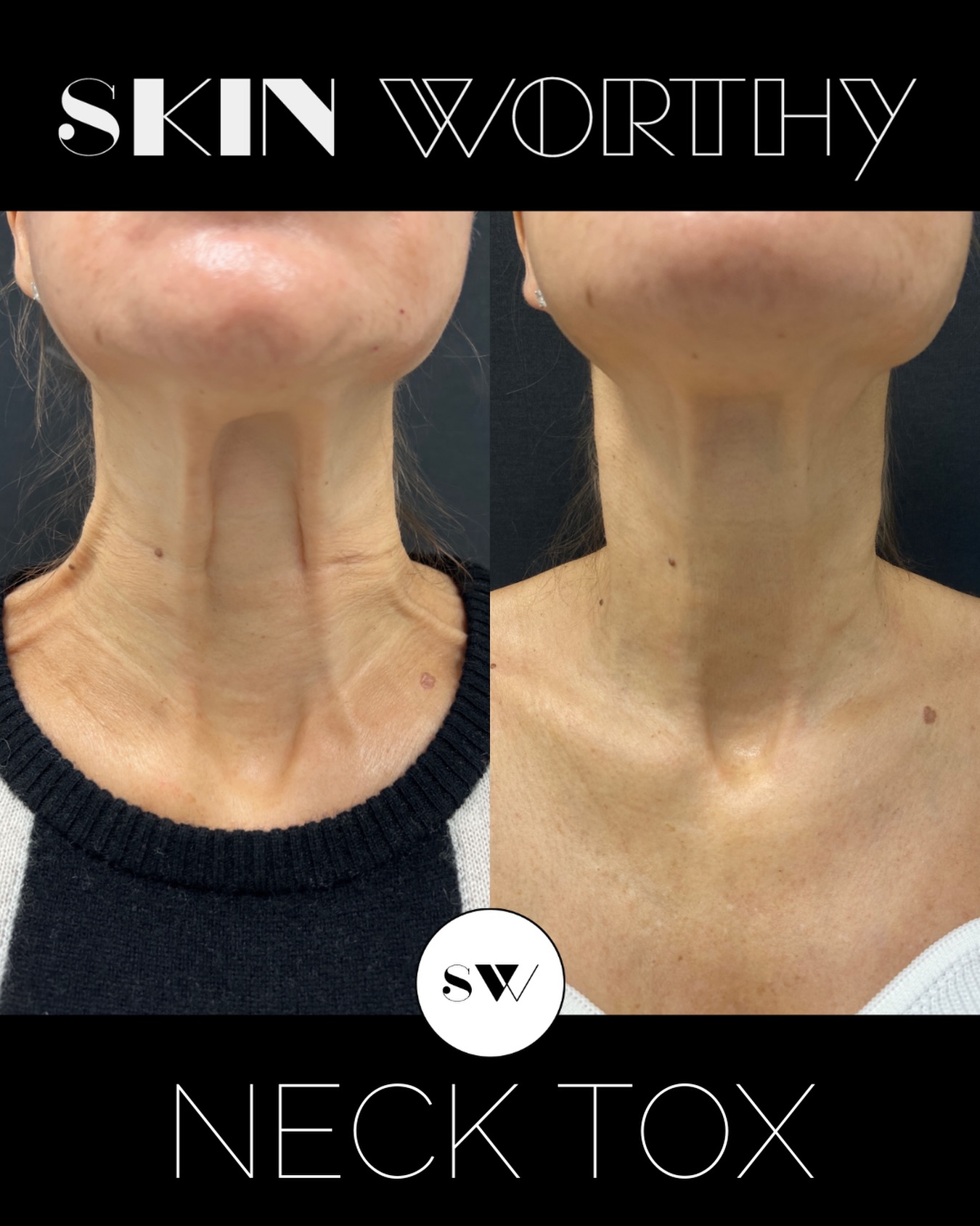 Microtox for the neck?
You’ve maybe heard of Nefertiti Neck lift using Botox, but in addition to using tox to treat the platysmal bands, tighten the jawline and elongate the neck, we can also use it in micro droplets to improve the appearance of crepiness on this thin-skinned area.
Photos are taken two weeks apart, day of and 2 weeks post treatment. While we love using M8 and resurfacing lasers on the neck to improve skin quality, we also know you care about its appearance while you’re waiting for your results. Microtox in the neck, is a great way to achieve it.
For more on injectables, or to start your own Beauty Evolution, call or text 647-350-7546