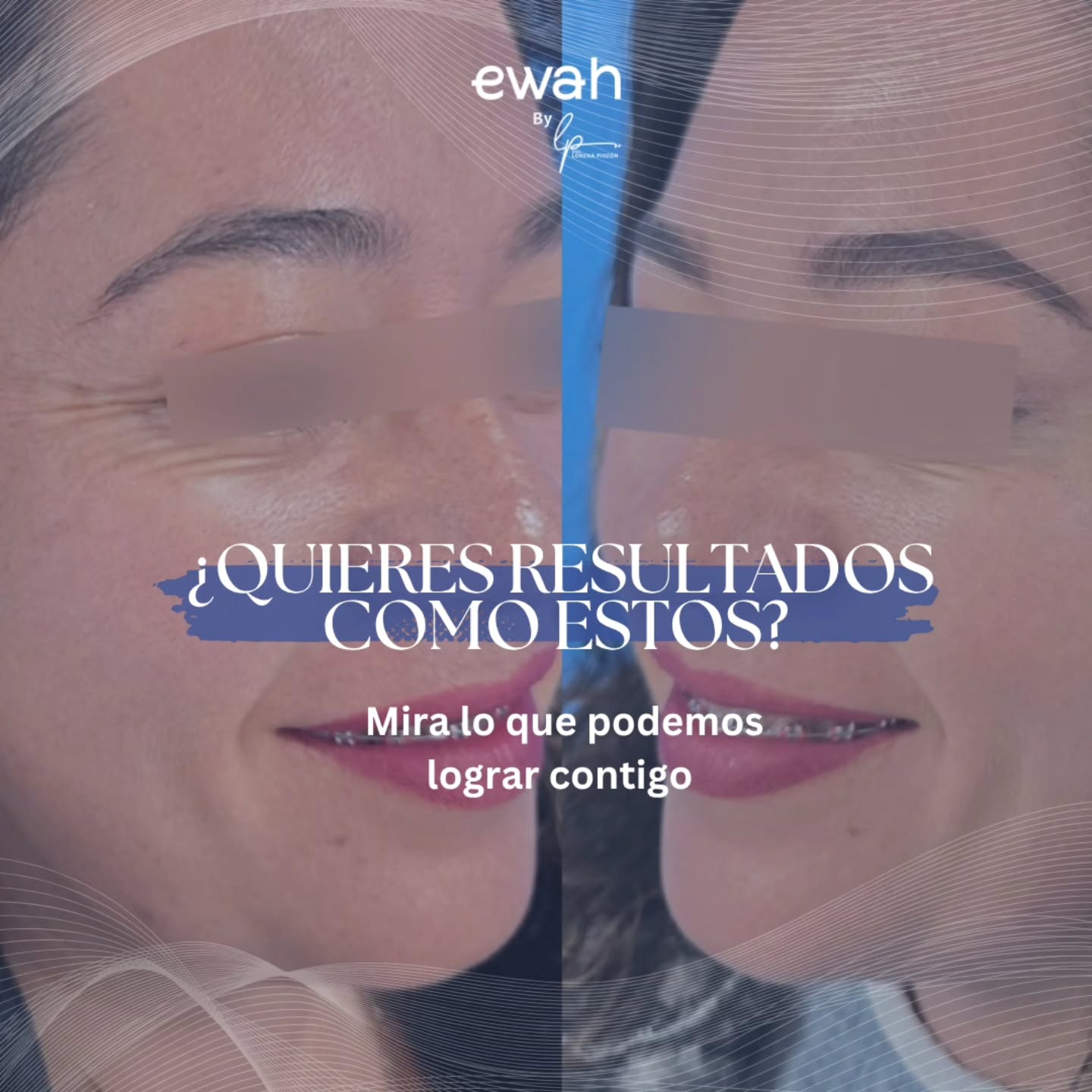 Mitos vs. Realidad: La Toxina Botulínica tipo A. 👩⚕️💉
Mucha gente teme al "efecto Botox", pero la clave de un buen resultado es la técnica médica. En esta publicación de antes y después de Toxina Botulínica, observamos la relajación selectiva de los músculos corrugadores (frente) y orbiculares (ojos).
¿Qué logramos?
1️⃣ Eliminación de arrugas dinámicas.
2️⃣ Prevención de líneas de expresión estáticas (futuras).
3️⃣ Una mirada más abierta y descansada.
En nuestra Clínica de Medicina Estética, priorizamos la armonía facial. El objetivo es que te digan "¿Qué bien te ves?", no "¿Qué te hiciste?". Un tratamiento experto garantiza resultados naturales y seguros.
¿Tienes dudas sobre la duración o el procedimiento? Déjalas en los comentarios o agenda una consulta médica.
📲 Link en la bio para tu valoración clínica.
#ToxinaBotulínica #BotoxAntesYDespues #EliminarArrugas #RejuvenecimientoFacial #MedicinaEstética MedicinaEsteticabogota Botoxbogota FrenteSinArrugas PatasDeGallo CuidadoDeLaPiel ClínicaEstética BellezaNatural RejuvenecimientoSinCirugía ResultadosNaturales
