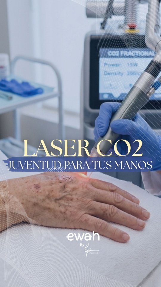 ¿Cómo eliminar las manchas y recuperar la juventud en tus manos? 👇
El rejuvenecimiento de manos con Láser CO2 Fraccionado es el tratamiento médico más efectivo para revertir los signos del envejecimiento. A diferencia de las cremas, el Láser CO2 actúa en las capas profundas de la piel para:
✔️ Borrar manchas solares y lentigos (manchas de la edad).
✔️ Estimular de forma natural la producción de colágeno y elastina.
✔️ Devolverle el grosor, la firmeza y la suavidad a la piel de tus manos.
En EWAH, nuestra clínica de medicina estética en Bogotá, contamos con tecnología de punta y protocolos médicos seguros para garantizar resultados visibles desde las primeras sesiones. No dejes que tus manos revelen tu edad; confía tu piel a expertos.
📍 Agenda tu cita de valoración en Bogotá:
📲 WhatsApp: 312 305 3887
🌐 Visita nuestro portal web para más información: www.ewah-derm.com
#RejuvenecimientoDeManos #LaserCO2Bogota #EliminarManchas #MedicinaEsteticaBogota #DermatologiaEstetica EWAH DraLorenaPinzon TratamientoLaser ManosJovenes