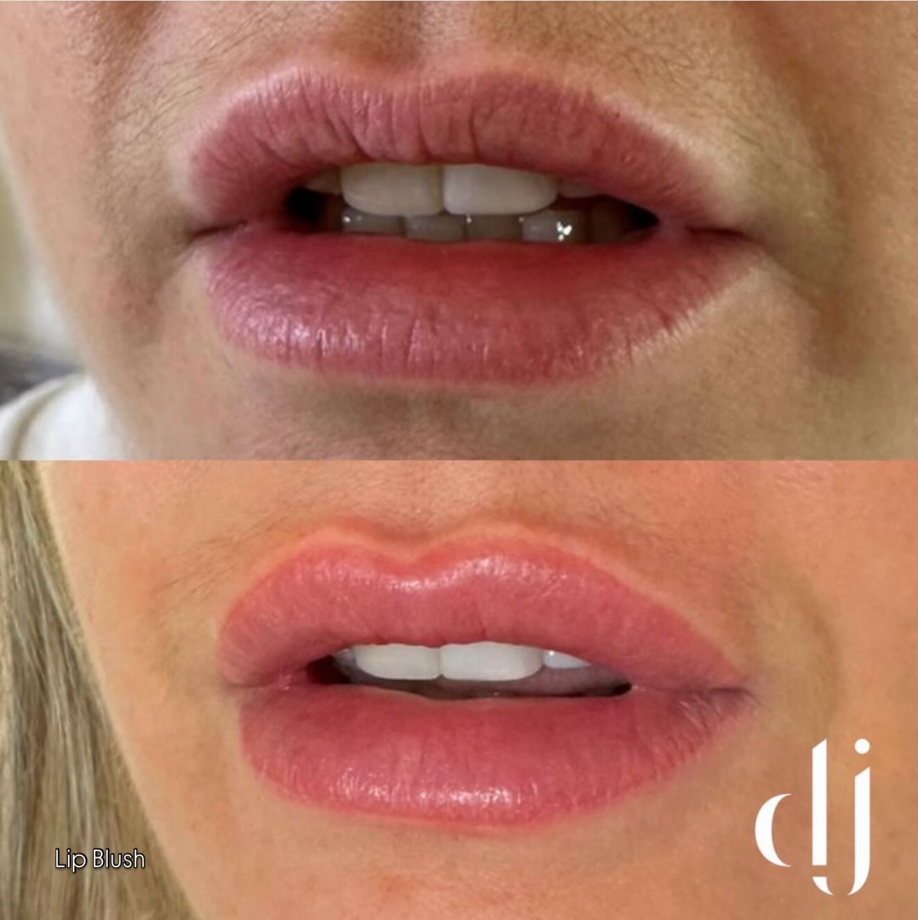 Lip Blush results straight from treatment
Before vs After (what actually changes)
BEFORE
* Lips may look:
* Pale or uneven in colour
* Less defined around the edges
* Slightly dull or “washed out”
* Some people also have darker patches or cool tones they want corrected
AFTER (immediate)
* Right after the procedure:
* Lips look brighter, darker, and more defined
* Slight swelling is common (can look fuller temporarily)
* Colour can appear 30–50% stronger than final result Pale or uneven in colour
* Less defined around the edges
* Slightly dull or “washed out”
* Some people also have darker patches or cool tones they want corrected
AFTER (immediate)
* Right after the procedure:
* Lips look brighter, darker, and more defined
* Slight swelling is common (can look fuller temporarily)
* Colour can appear 30–50% stronger than final result
#lipblush #permamentmakeup #pmu #lipblushliverpool