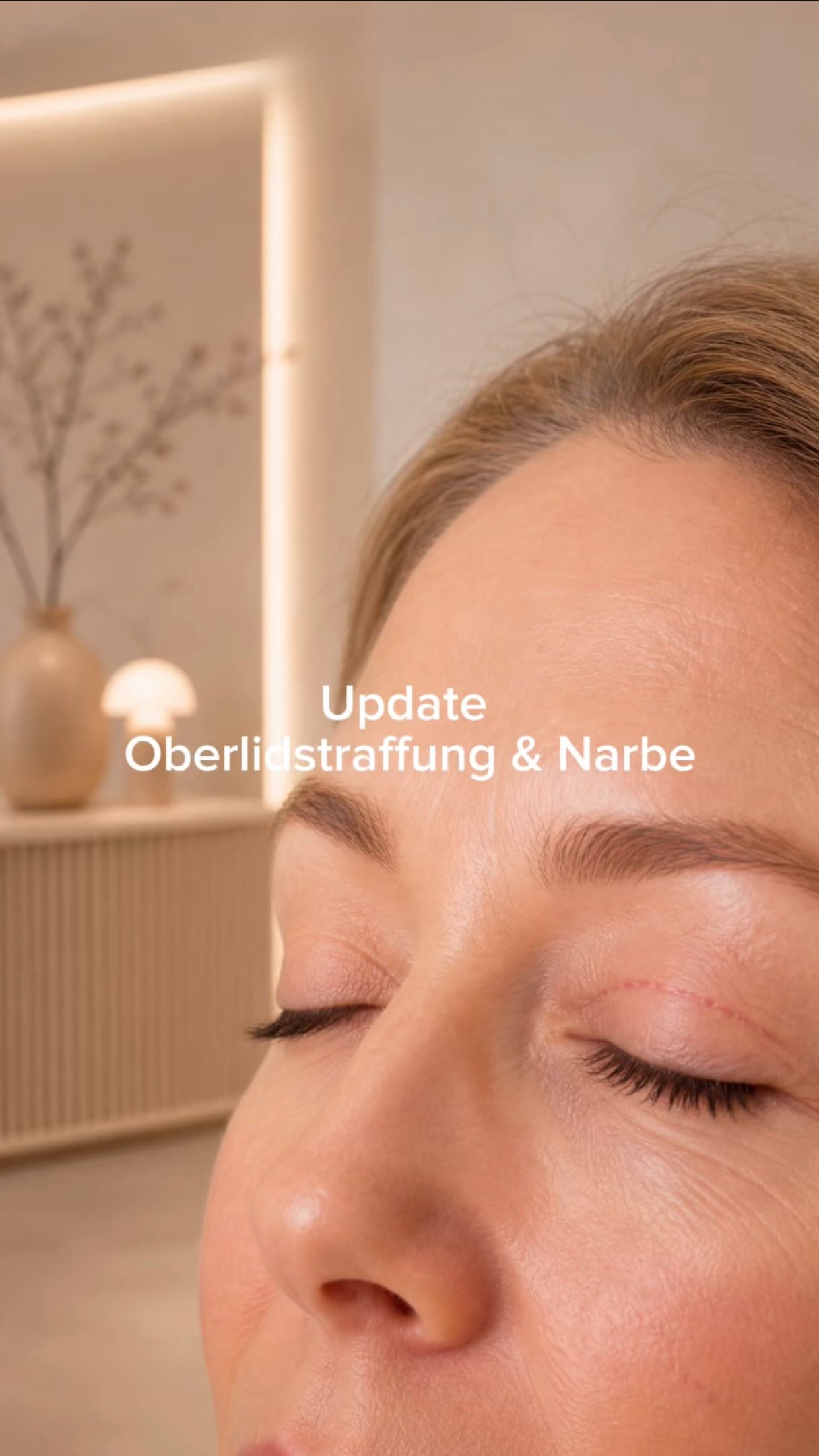 Oberlidstraffung – 4 Wochen später 👀✨
Die Narbe ist schon super fein, liegt in der Lidfalte und wird mit der Zeit noch unauffälliger.
#eyelidlift #blepharoplasty #plasticsurgery #aesthetics #healingprocess