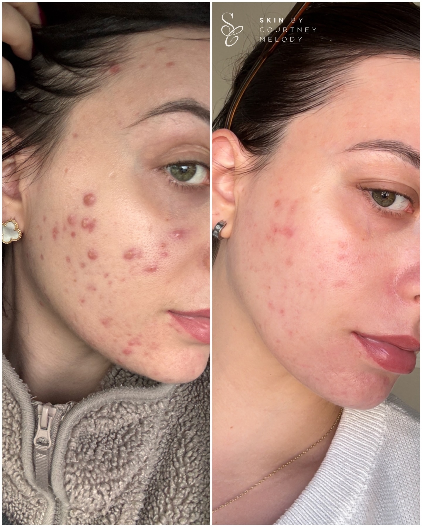 My skin! November 25 - now!
I put these 2 images together this morning and thought I’d share. Why? Well because actually between this time, my stress has been high, I’ve been on medication and my diet hasn’t been great, but my skin has improved! 🤣 so quite the contradictory to everything we’re (or I) tell to heal skin! But as always, nothing is ever simply black and white.
Following my crazy acne outbreak from my B12 injections last year, the closed comedones they had given me turned into nodular and cystic acne up my cheeks, which resulted in quite intense PIE marks ☹️
At the moment, I’m contraindicated to the typical treatments I’d do to treat scarring and PIE, so my skincare routine has needed to do a lot of heavy lifting. I’ve invested in a solid skincare routine with active ingredients as well as 3 BYONIK treatments!
I still have a little way to go, but I’m hoping by the time I can do these treatments, my skin would have improved so much already. So it goes to show that whilst lifestyle factors are important, so is having a skincare routine tailored to you and doing it twice a day… yes clients I’m talking to you who’s products last you months on end, you aren’t using it enough 😉
Roll on when I can do SkinPen and IPL again!