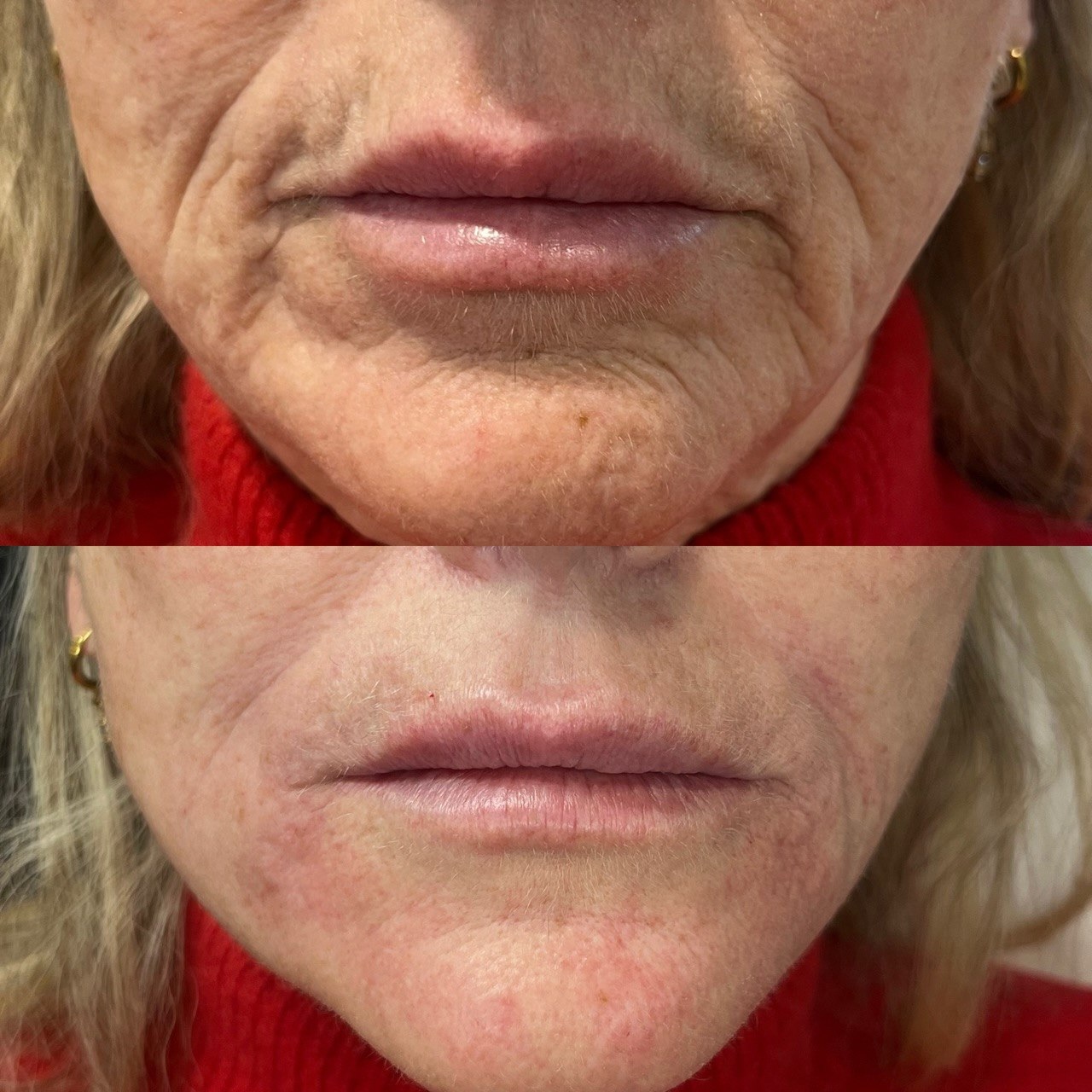 ✨ Oh la la… that lift 😍
No filters required. Just healthy, lifted, glowing skin.
Achieved in just 2 sessions ✨
Package price: €699
Natural results. Refreshed confidence.
Subtle, elegant enhancement — the way aesthetic medicine should be. 🤍
With love,
Priory Medical